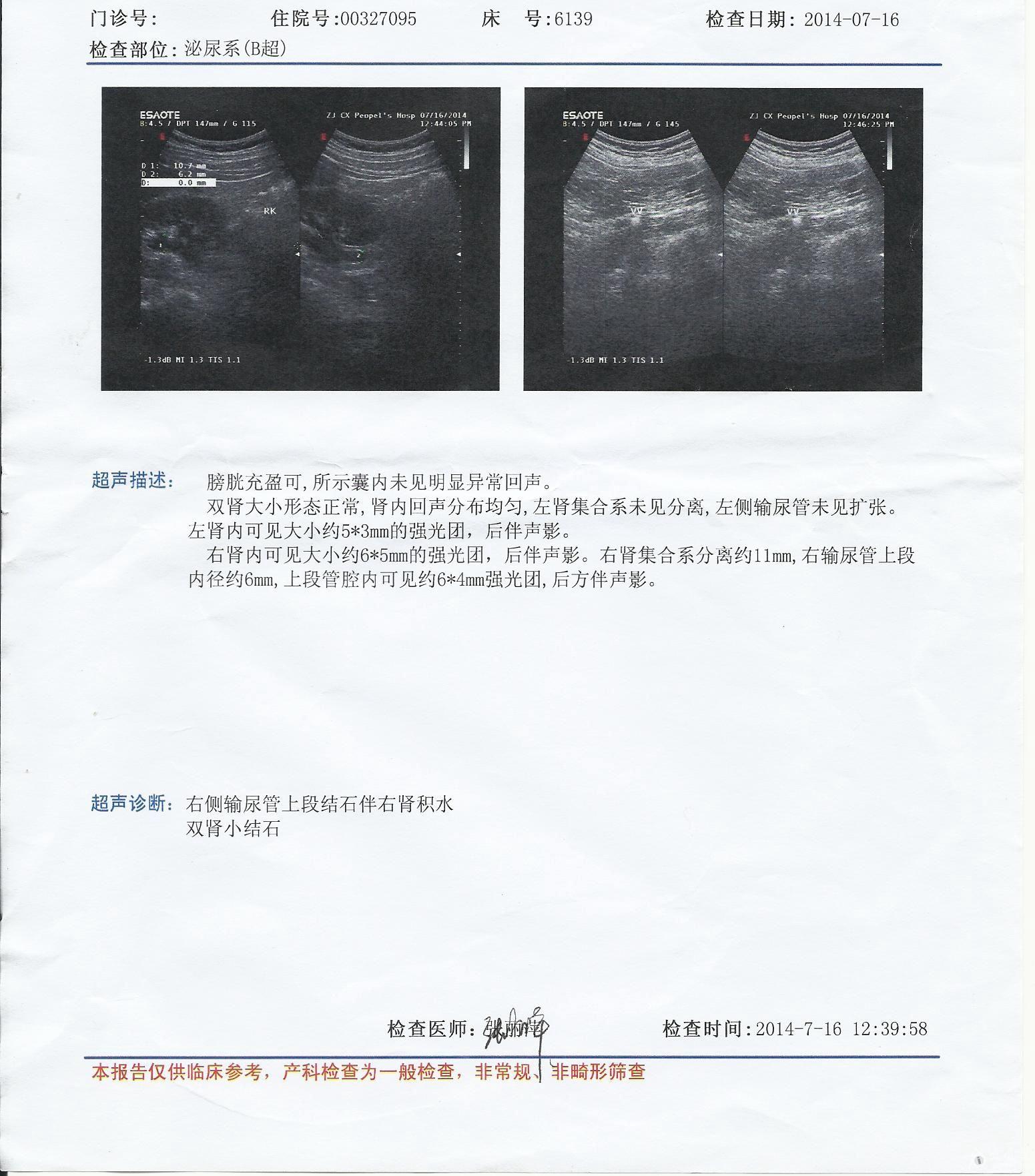 7月9日开始疼痛双肾结石右输尿管上段结石隐痛至今我该怎么办