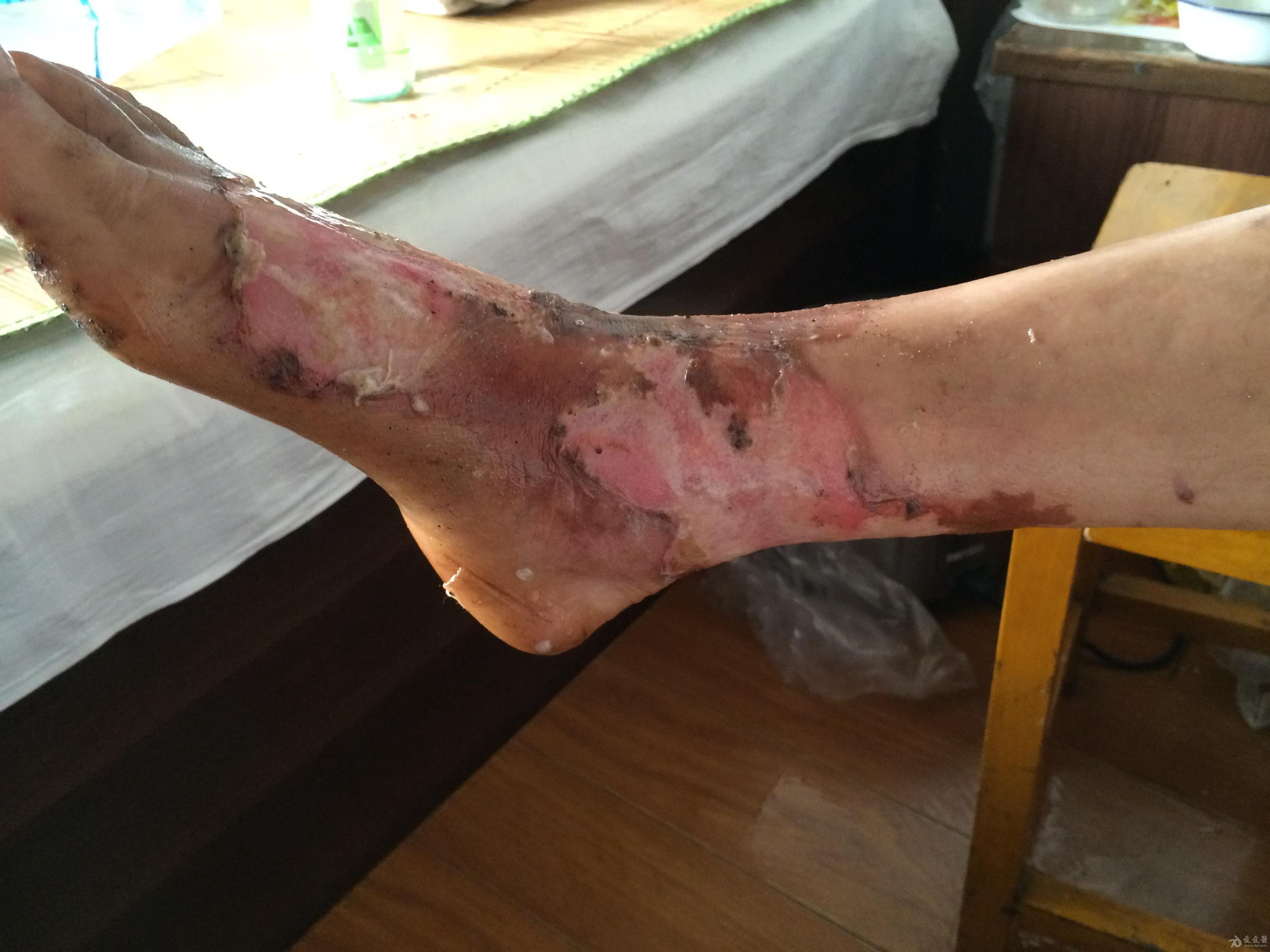 治疗1000多度的铜水烧伤患者的全过程