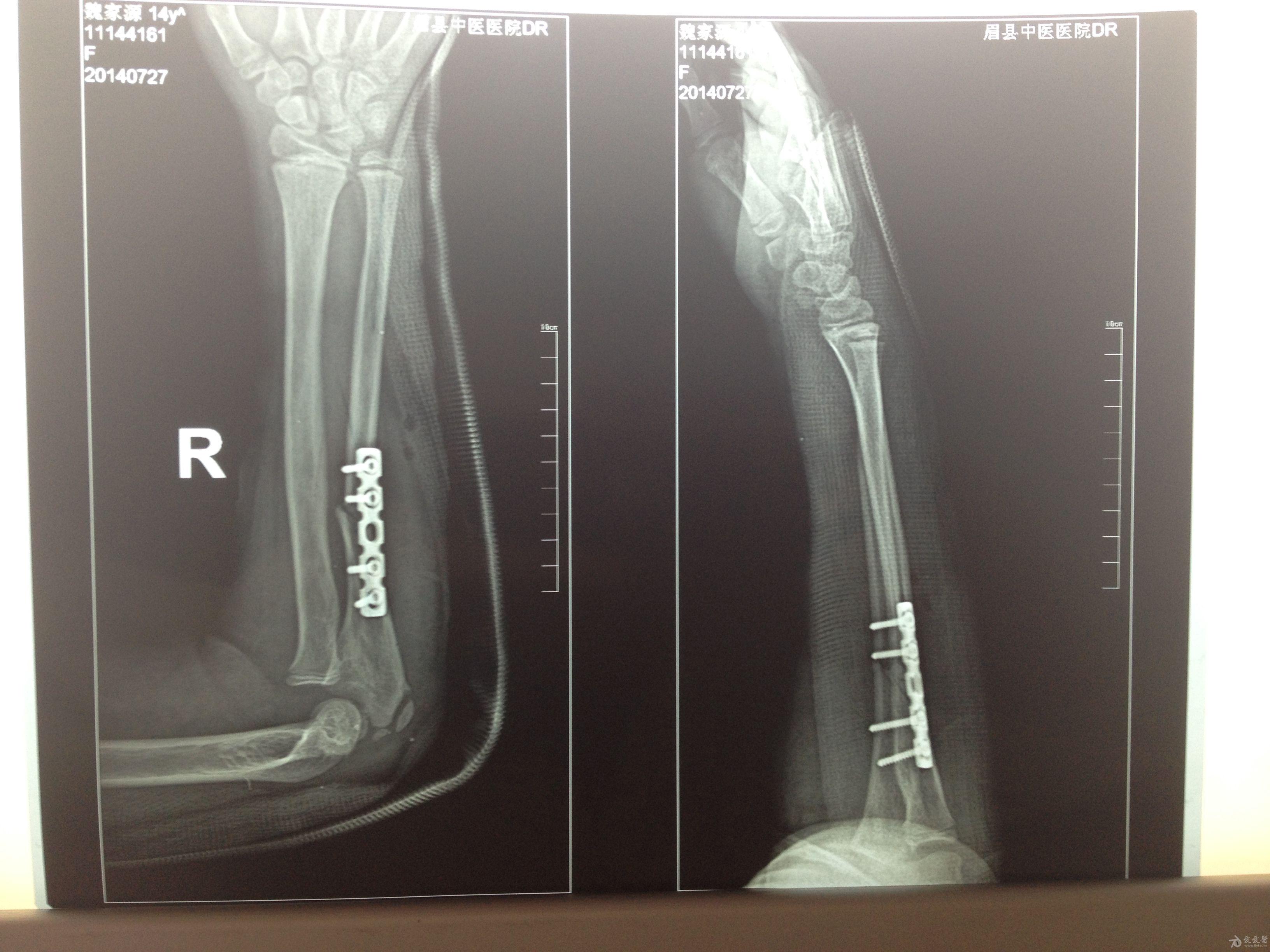 左桡骨下端骨折图片图片