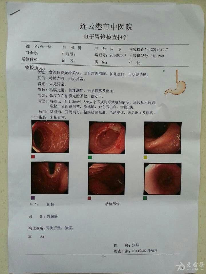 胃癌报告图片高清图片