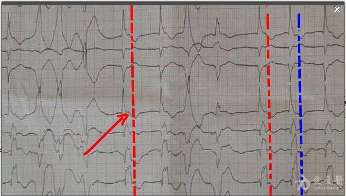 多源性室早心电图图片图片