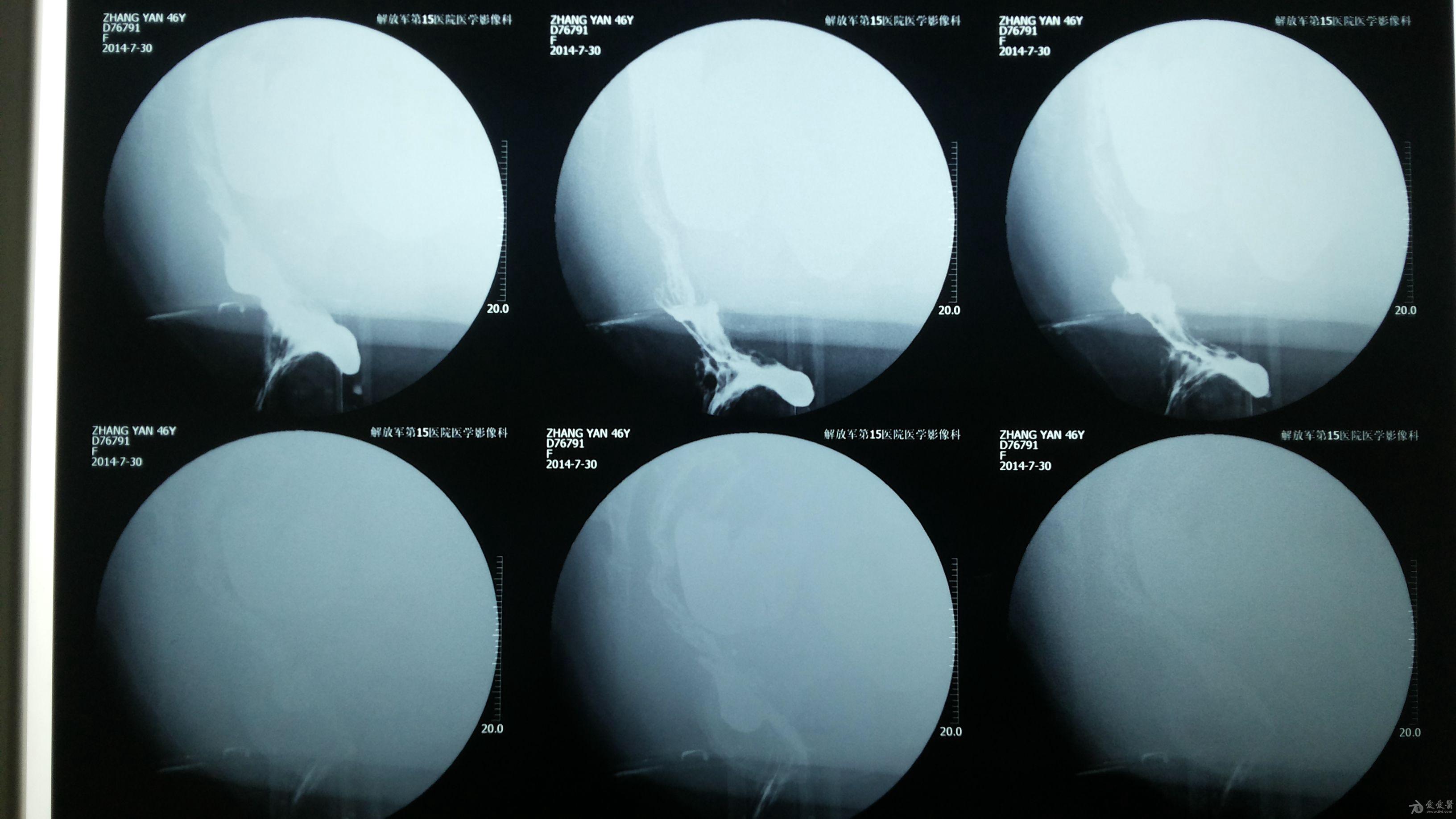 直肠前突的片子病人便秘请教处理方法