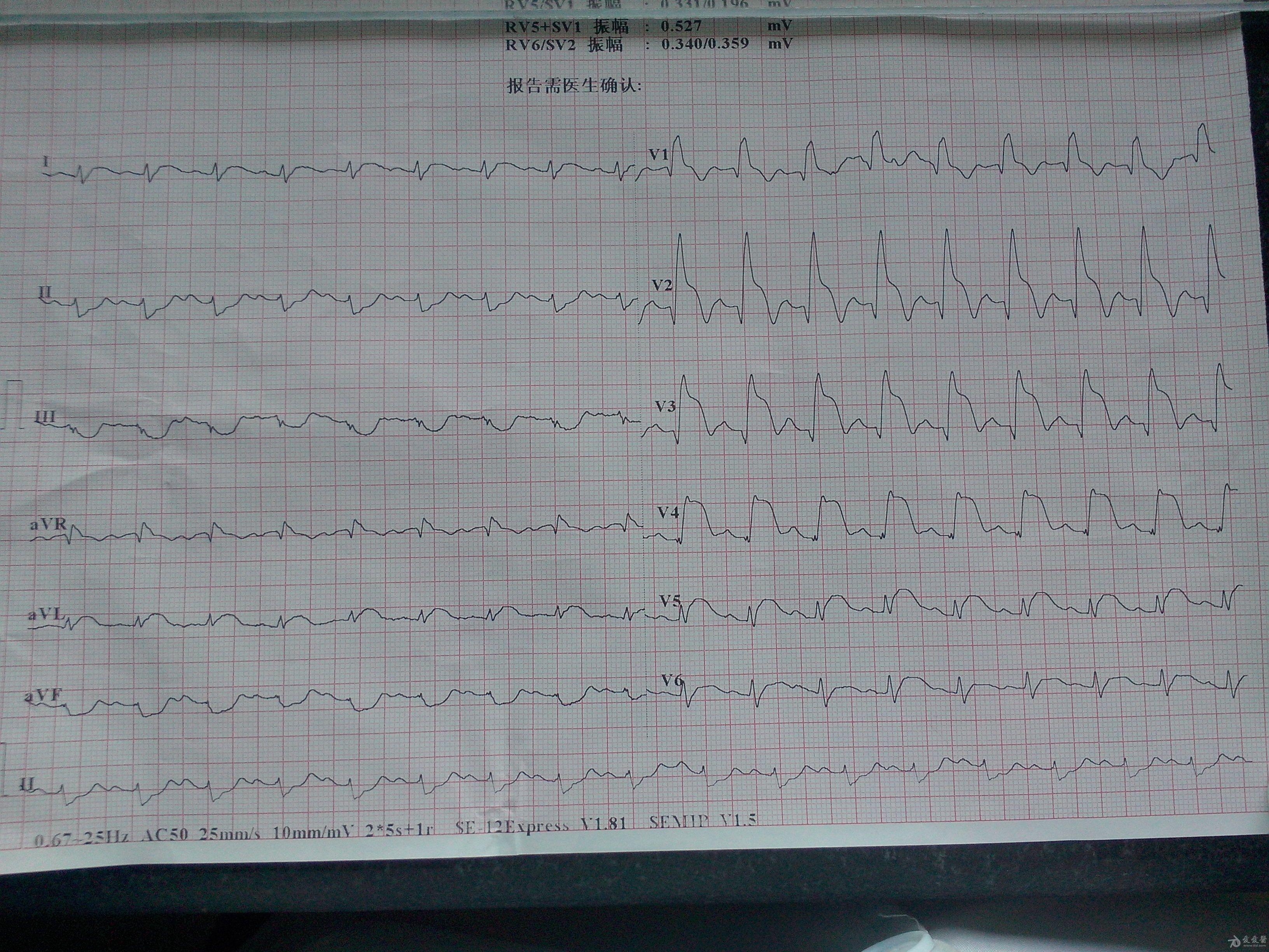 急性心肌梗塞!求师傅,斑竹指导分析