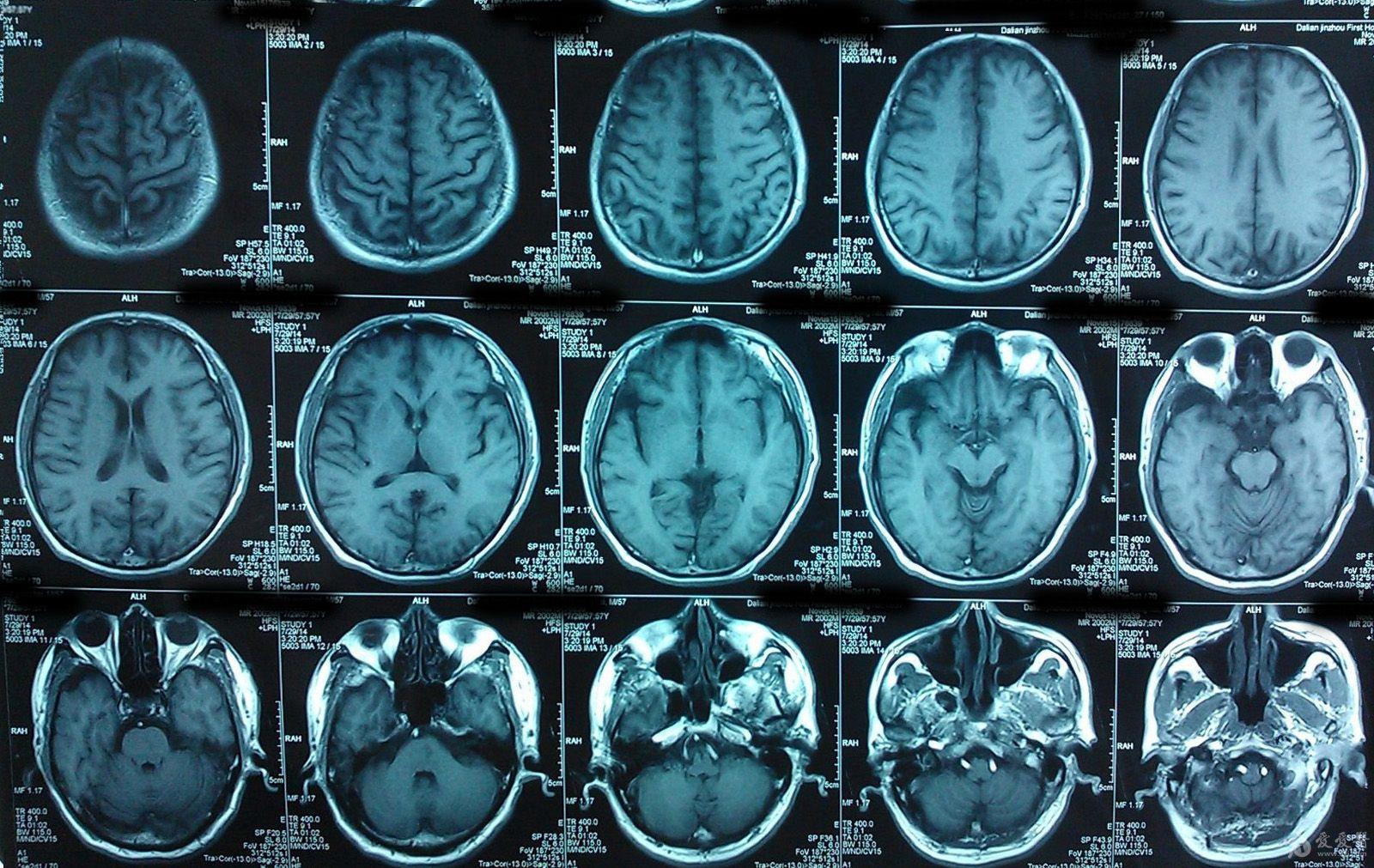 结果:小脑梗塞,责任血管应该是基底动脉穿支.  如图