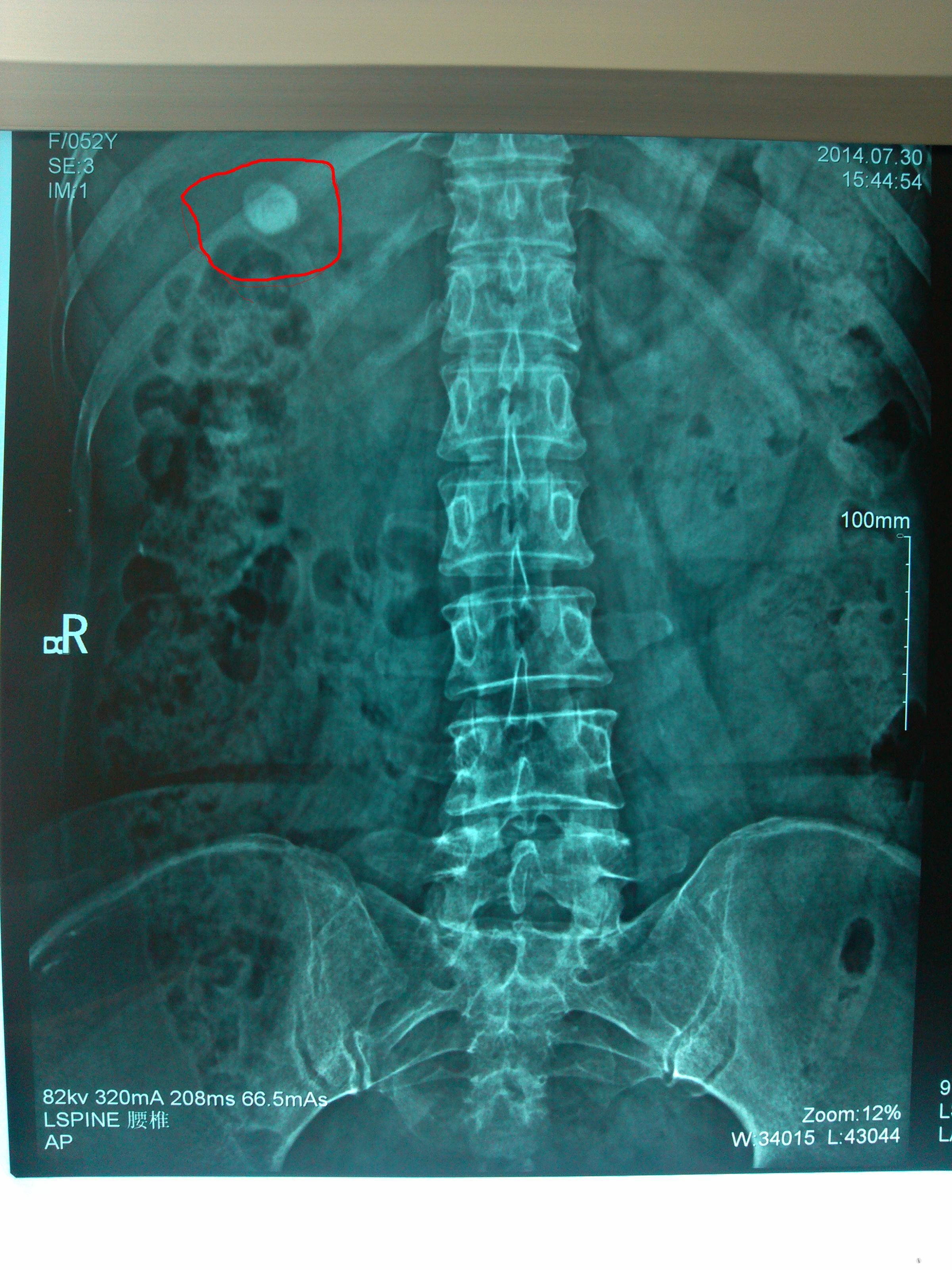 腰椎星形细胞瘤影像图图片