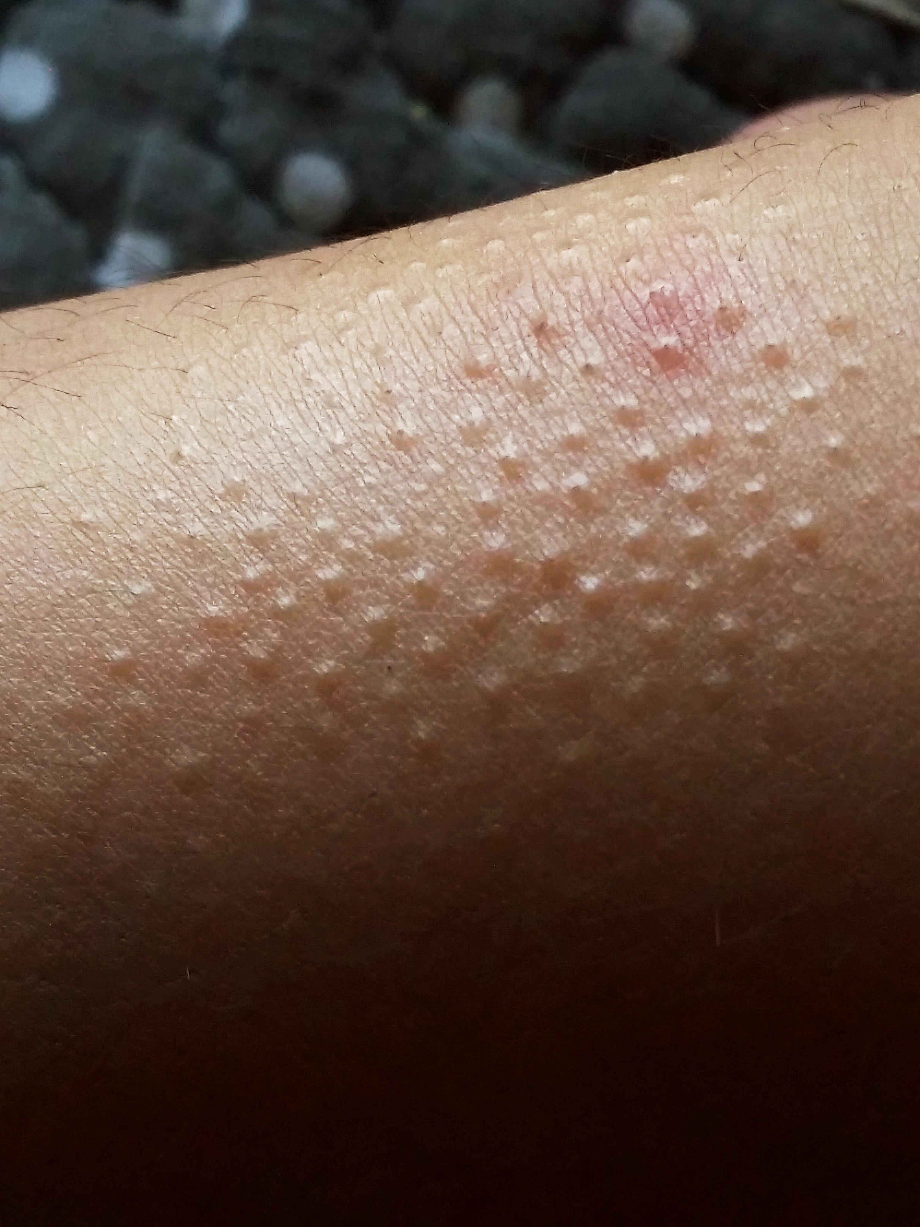 大家帮忙看看这种皮损是什么啊