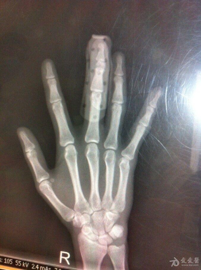 手指骨折图片 x光片图片