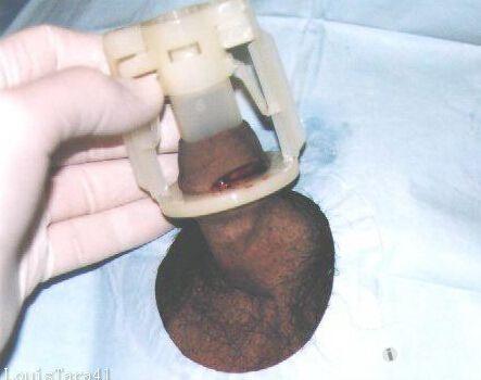 包茎套环手术过程图片