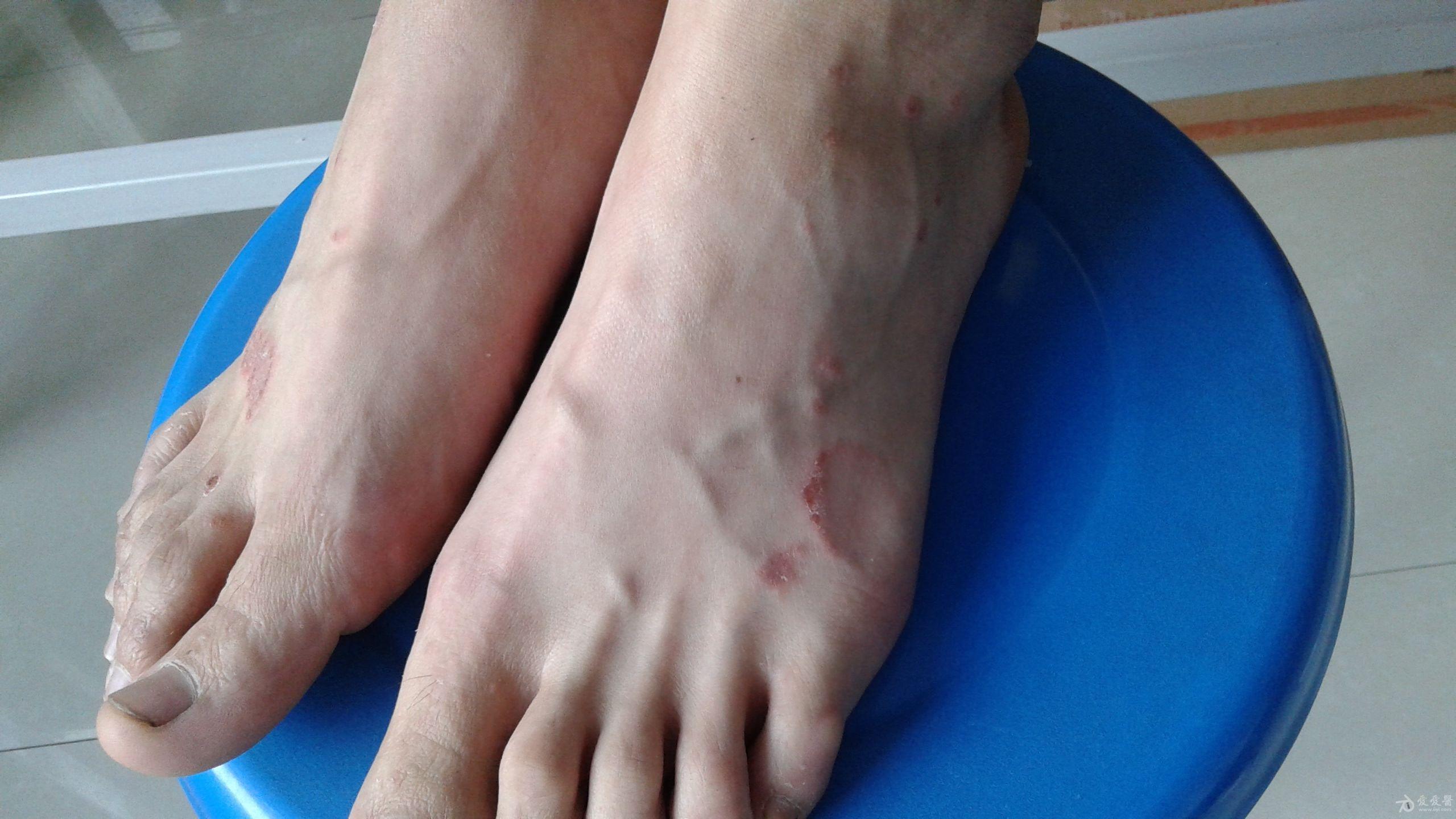 梅毒脚上的症状图片图片