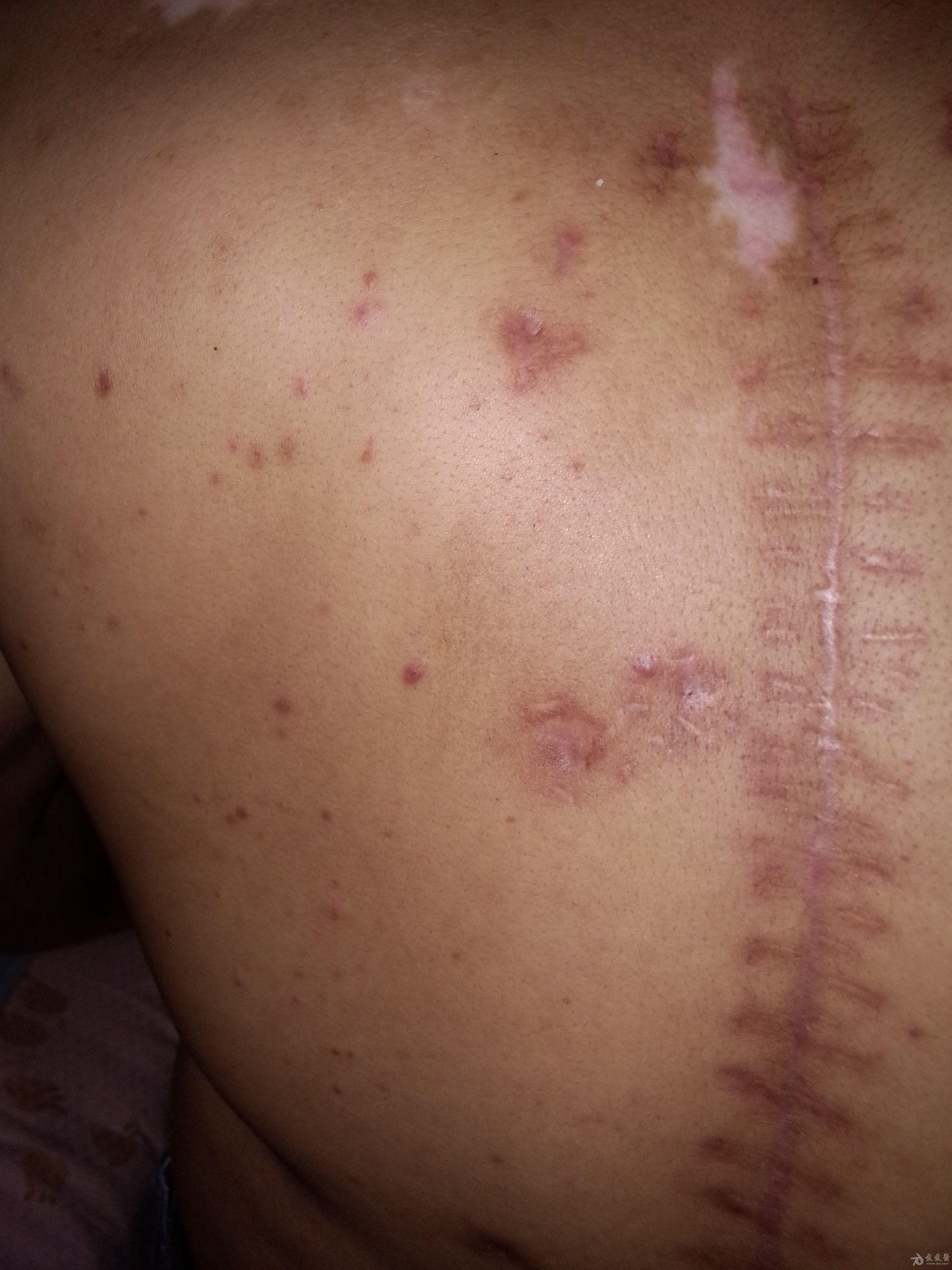 请求各位帮忙看下这是什么病怎么治疗 - 皮肤及性传播疾病讨论版