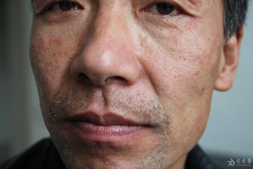 皮肤病成人麻疹