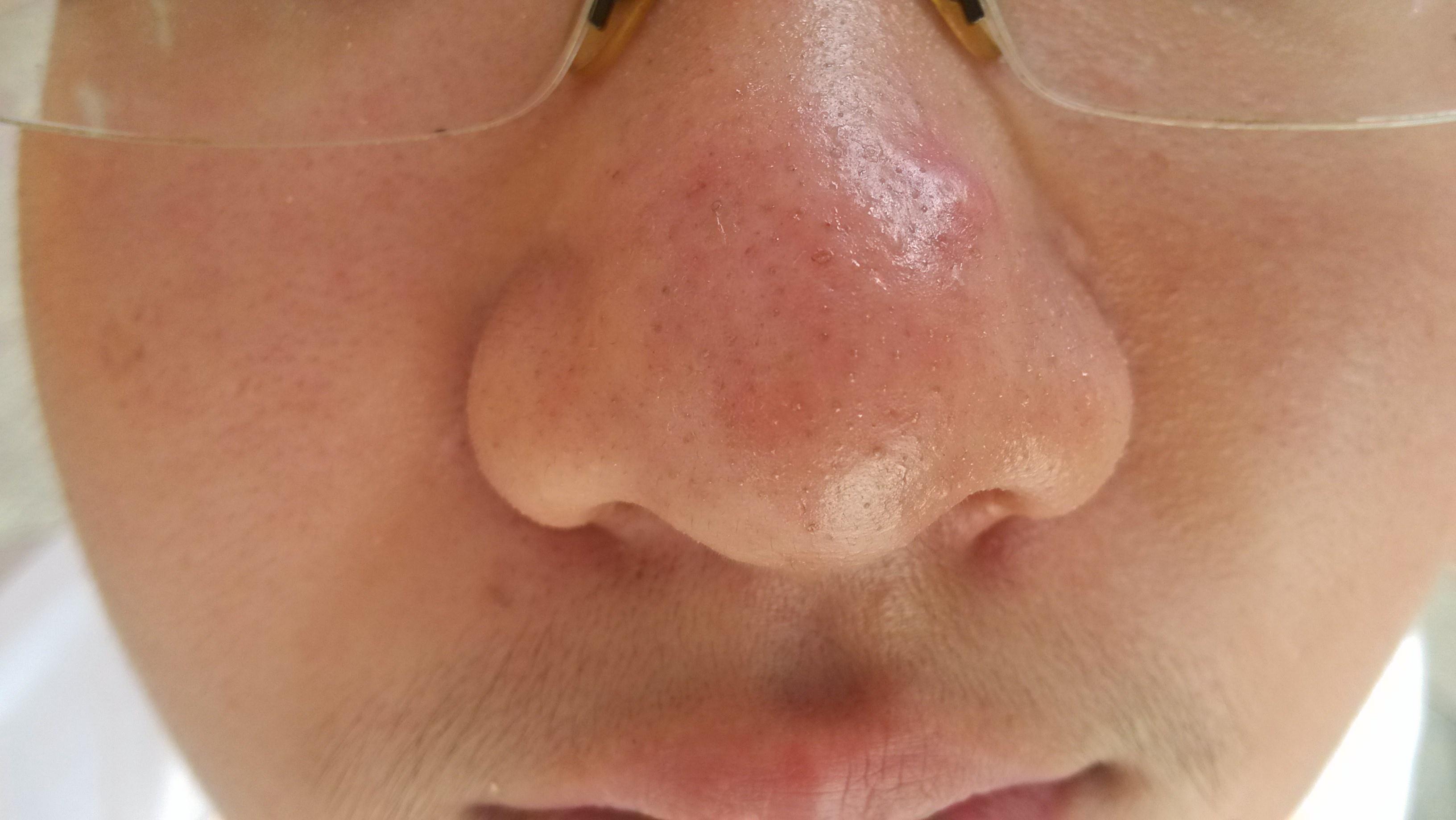 看看孩子的鼻子有好办法治疗吗