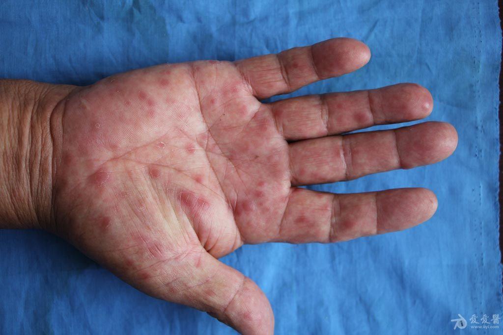 皮肤病84岁老人梅毒