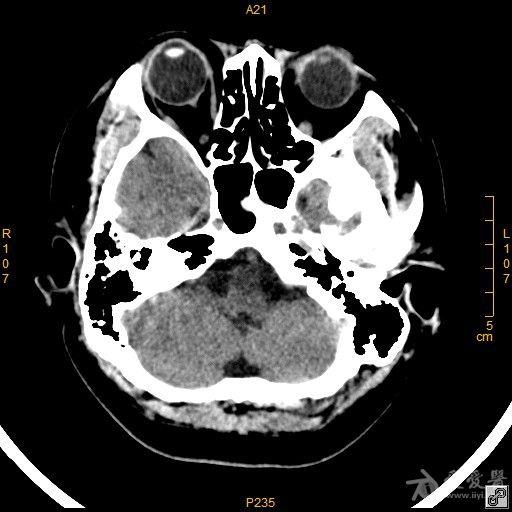 病例42鞍区脑膜瘤一例