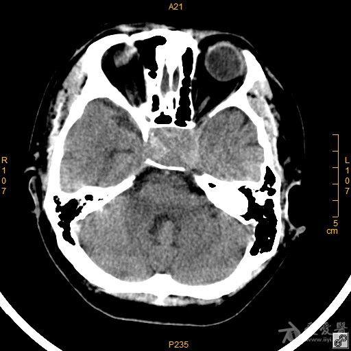 病例42 鞍区脑膜瘤一例
