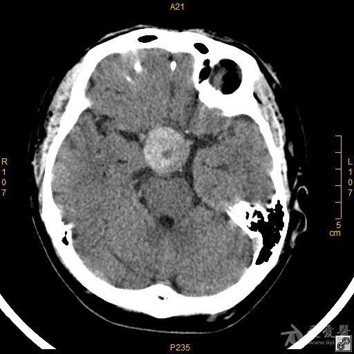 病例42鞍区脑膜瘤一例