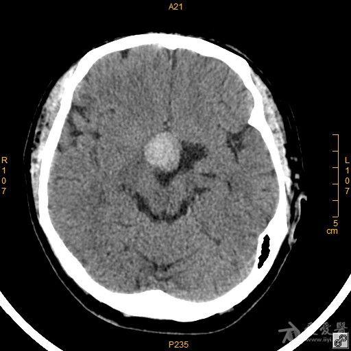 病例42 鞍区脑膜瘤一例