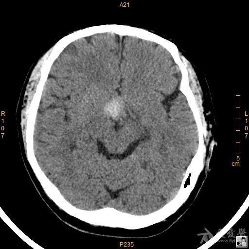 病例42 鞍区脑膜瘤一例