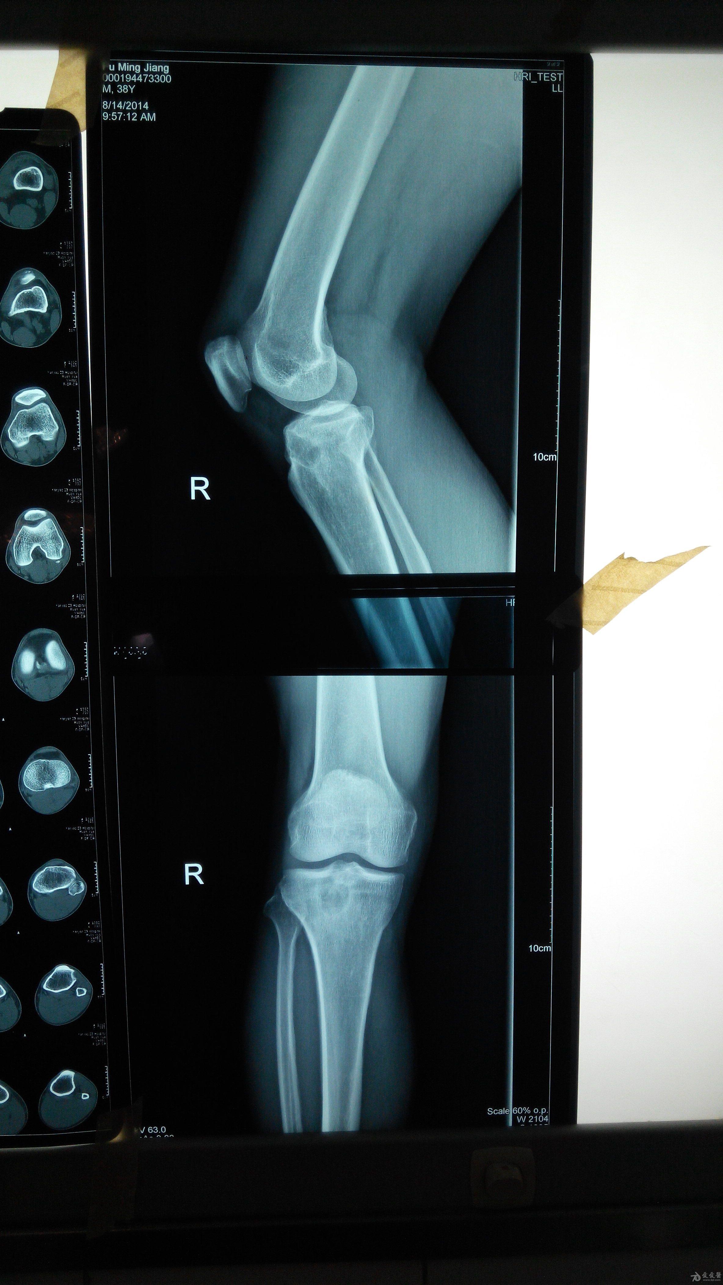 小腿骨肿瘤图片图片