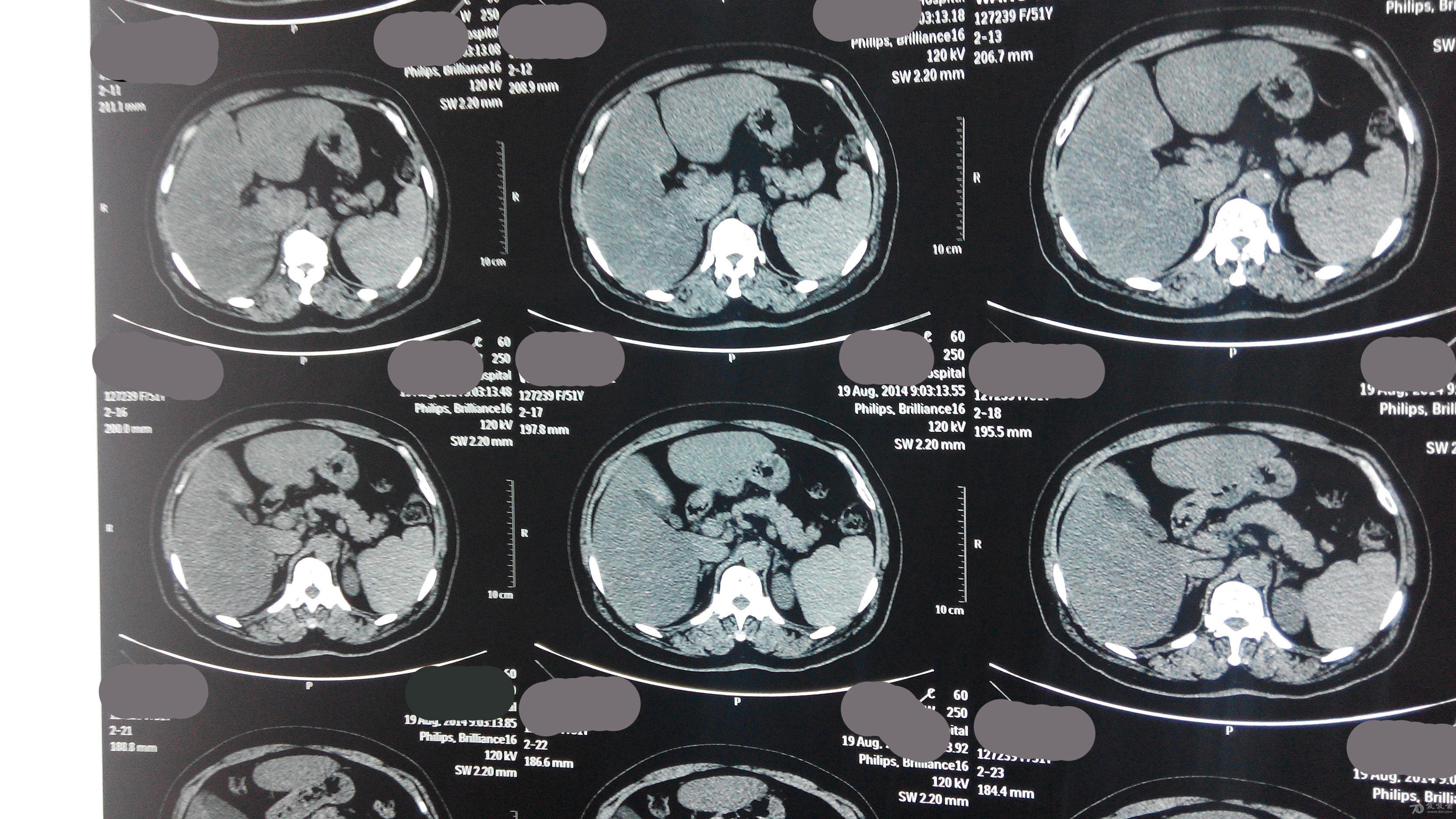 慢性胰腺炎CT图片