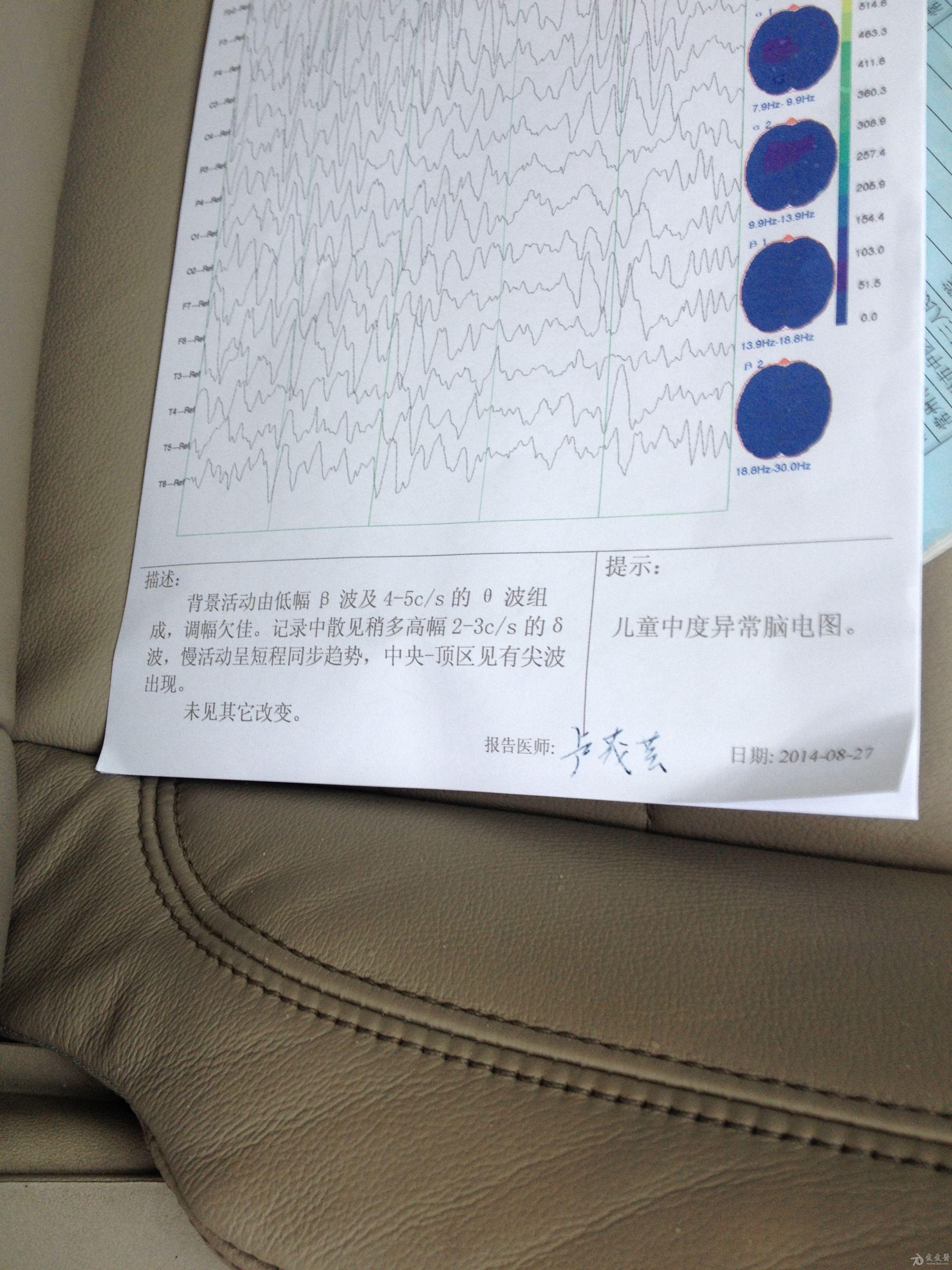 儿童脑电图正常值图片