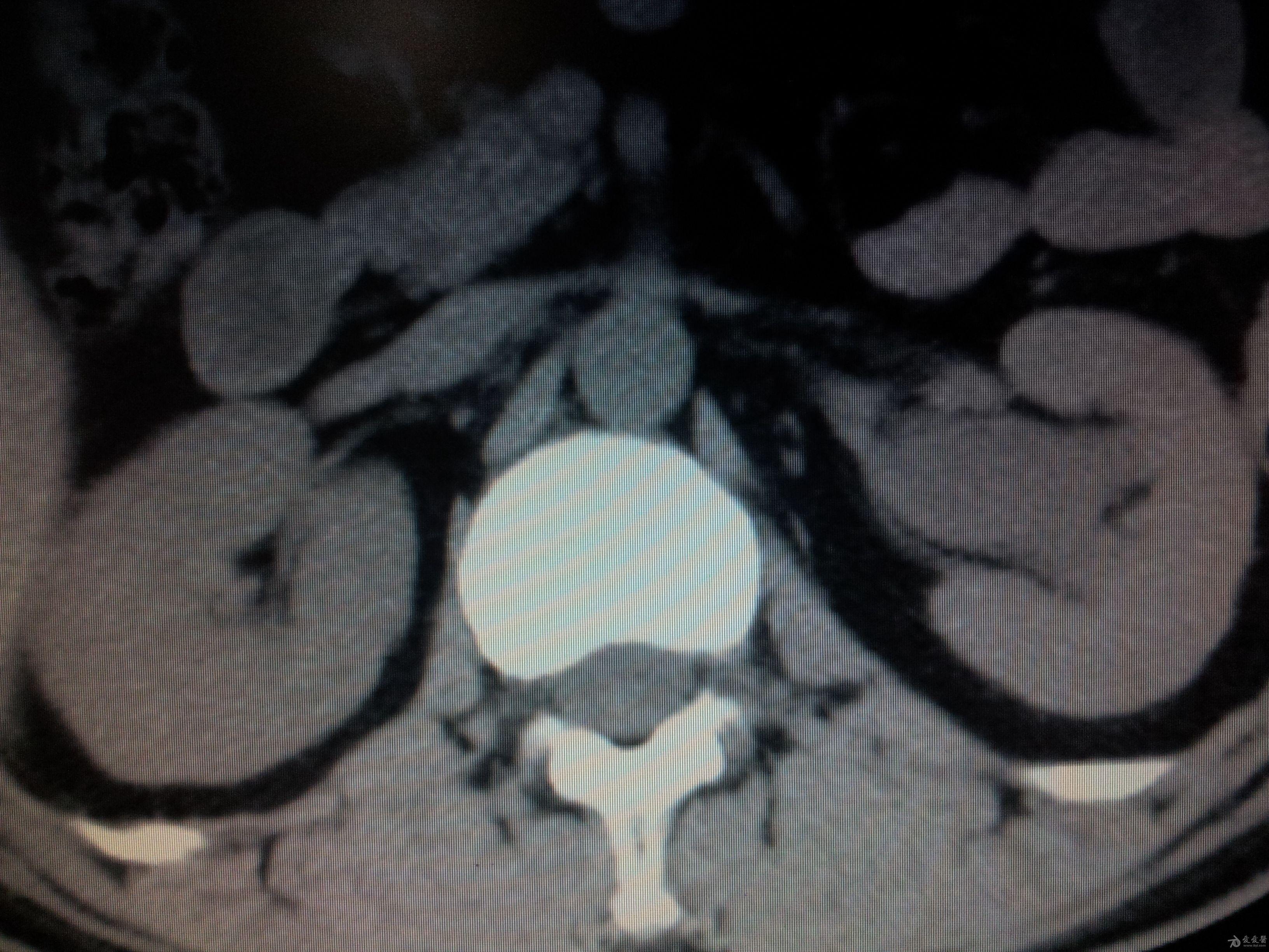 请问这个双肾ct考虑什么