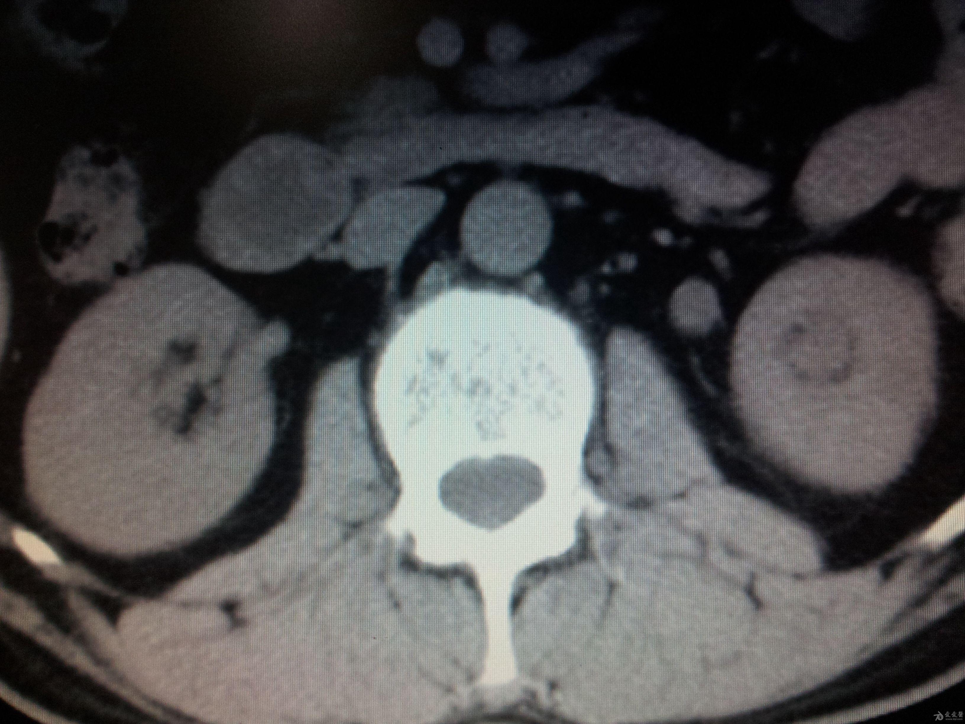 请问这个双肾ct考虑什么