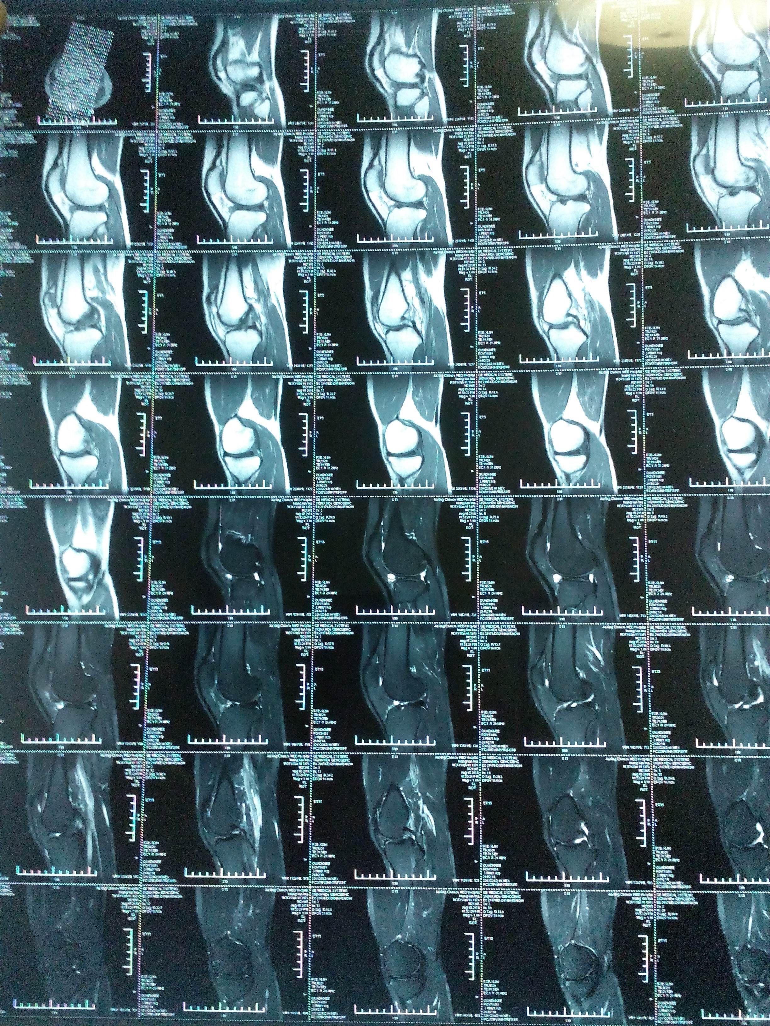 膝盖磁共振图像图片