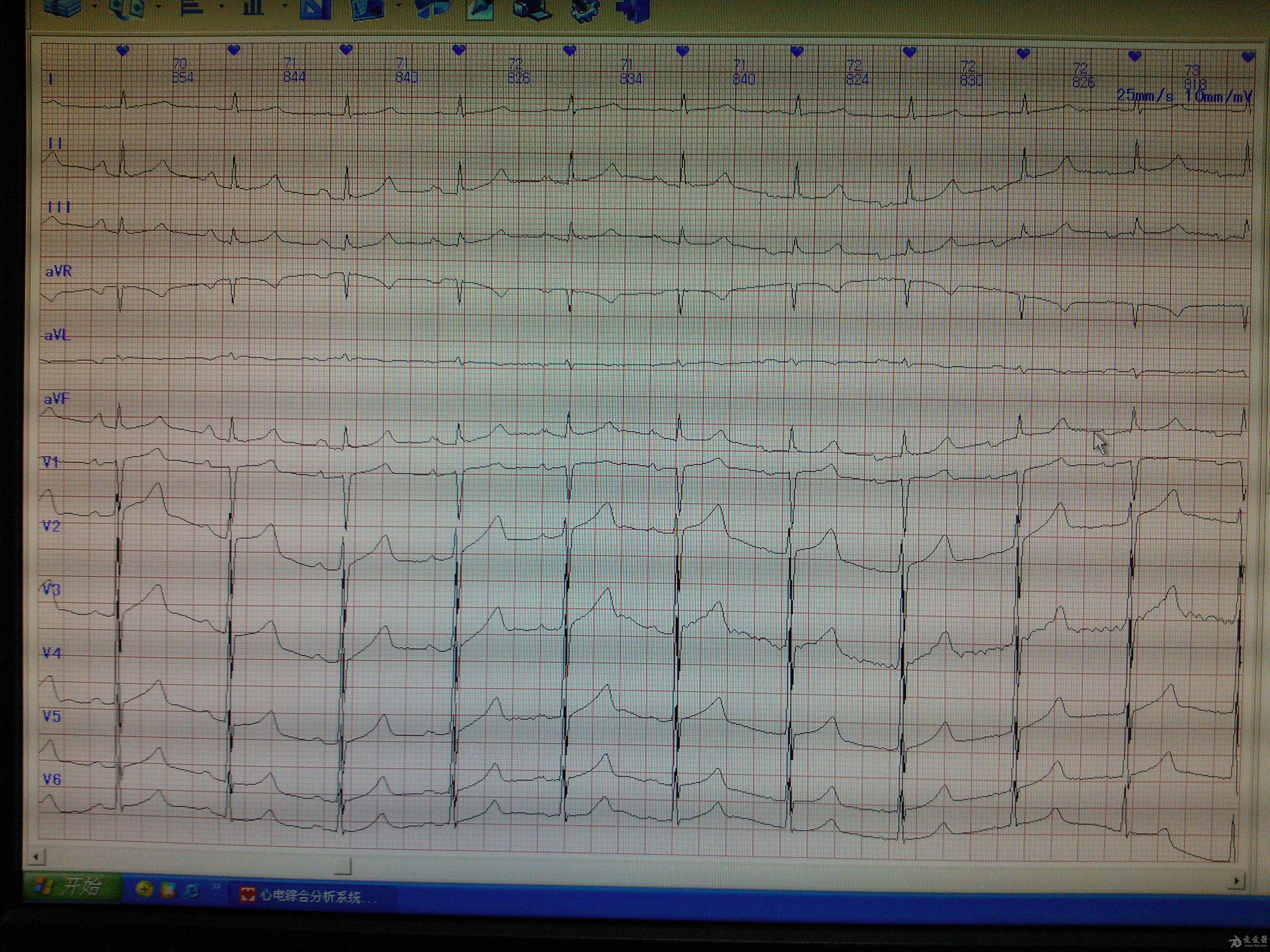 這個心電圖很有意思我跟我老師爭論了半天