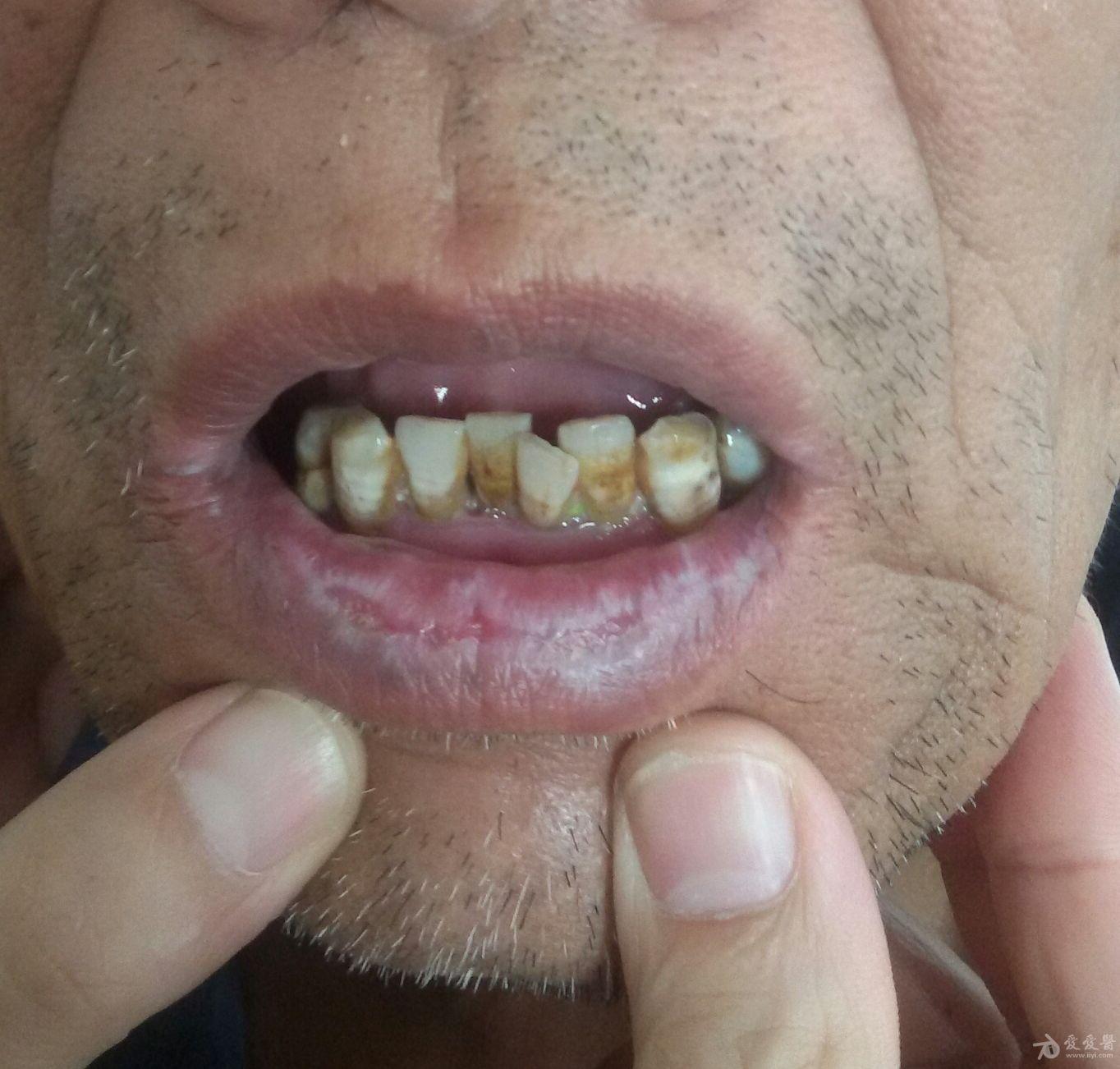 口唇粘膜糜烂反复10余年请诊断