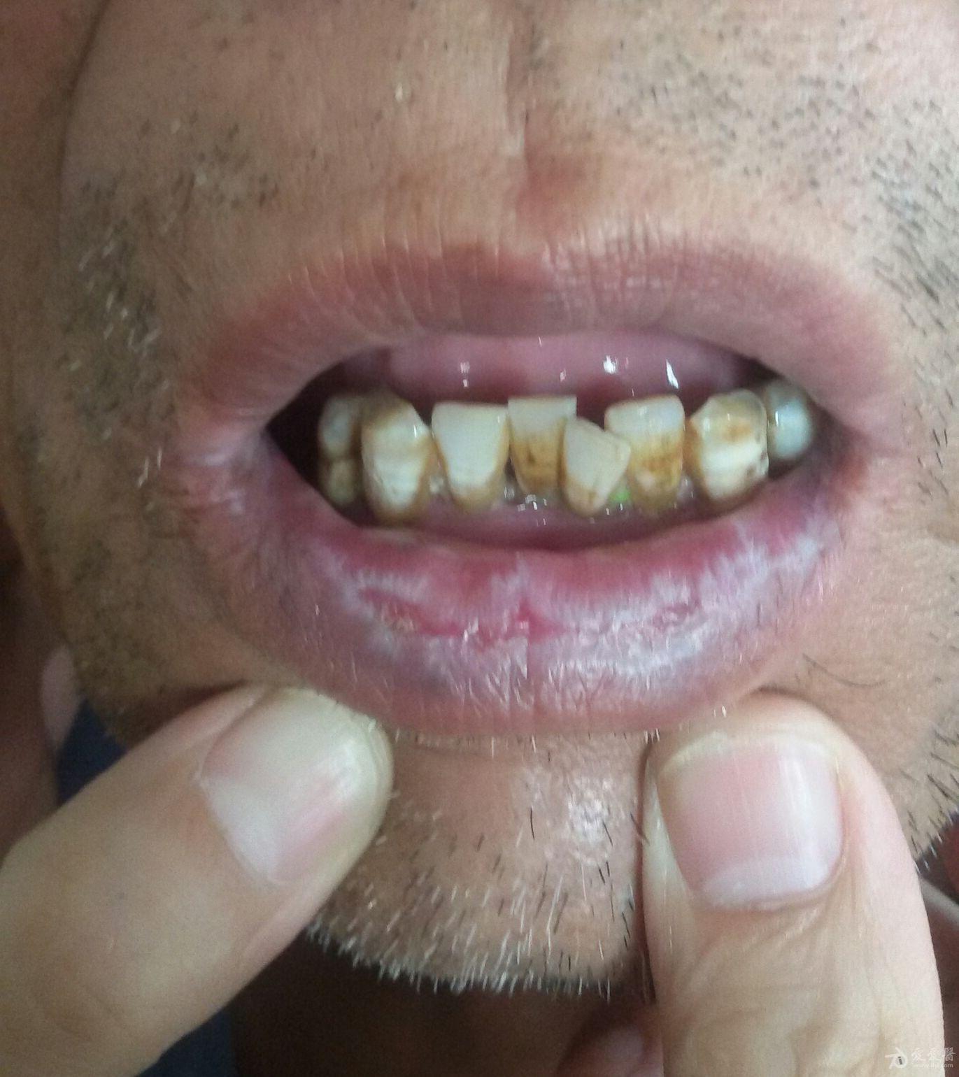 口唇粘膜糜烂反复10余年请诊断