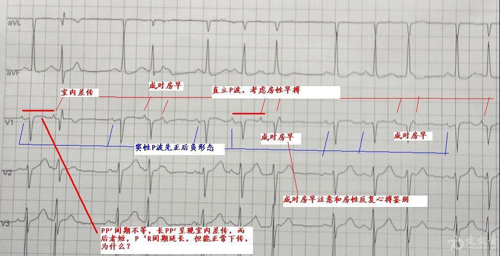 请各位老师帮忙看看这份心律失常 