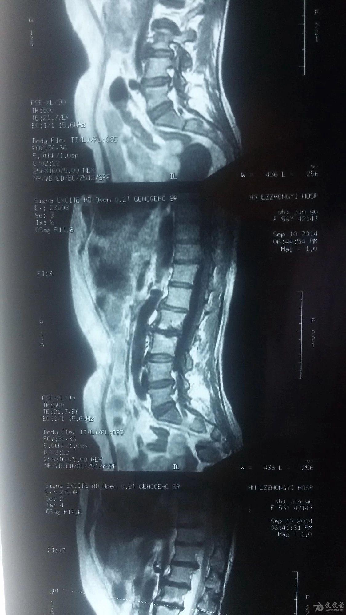 骨结核X光片图片