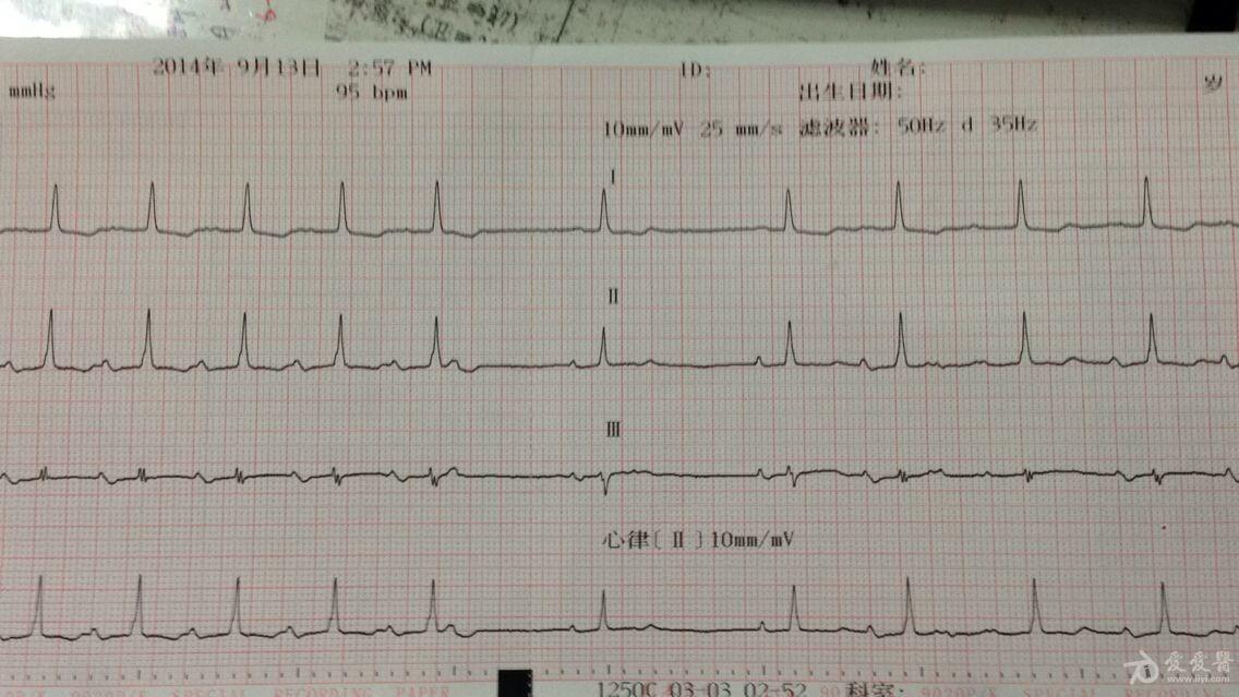 心梗一月餘複查的心電圖