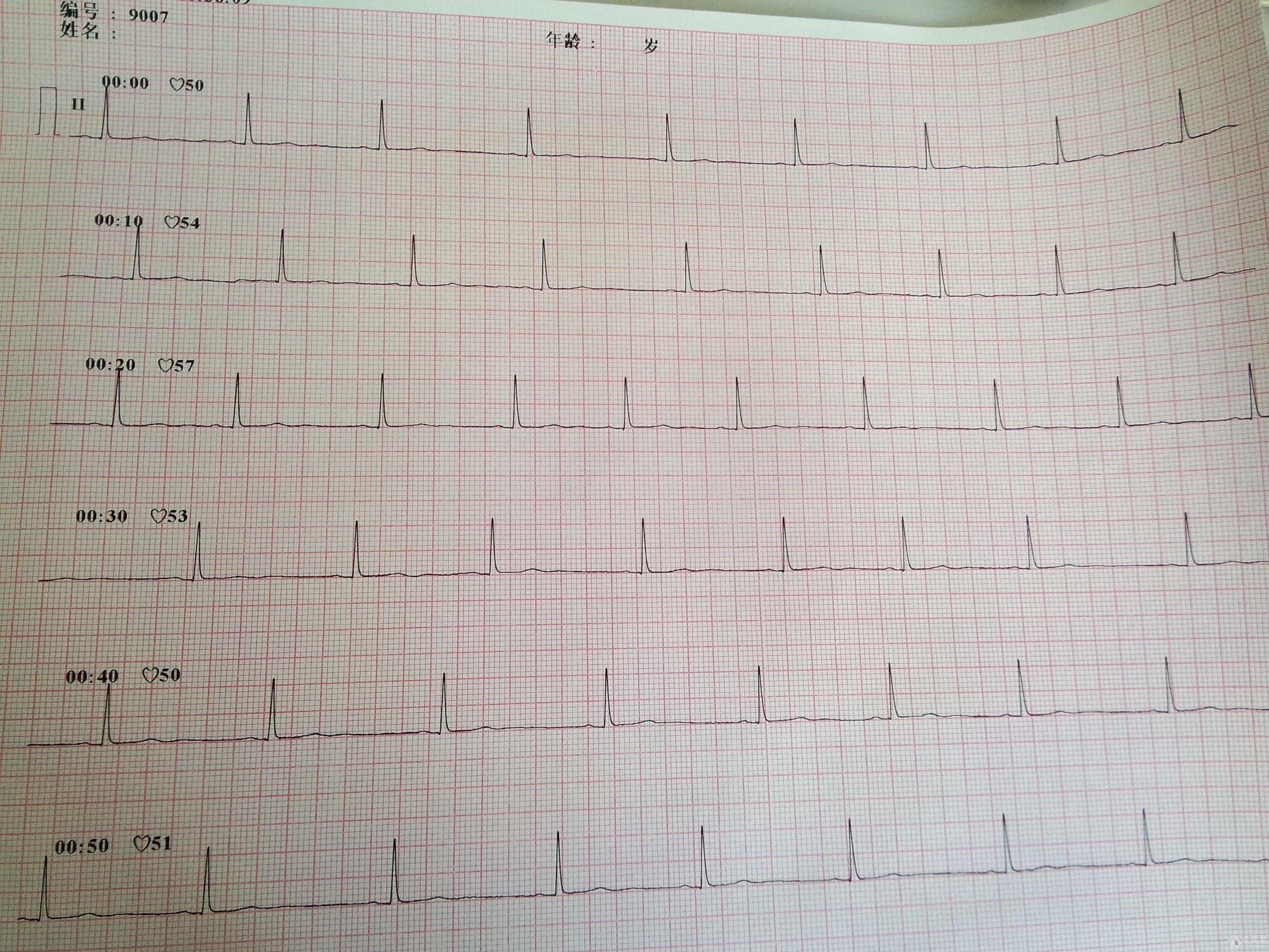 求 山羊老師幫忙讀ecg@! - 心電圖腦電圖專業討論版 - 愛愛醫醫學論壇