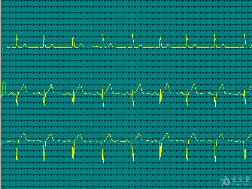 一個年輕人的心電圖qrs波很奇怪918日更新最新彩超結果出來了