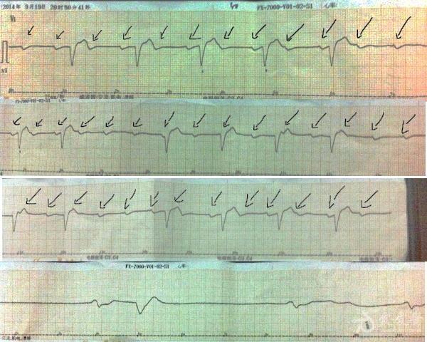 临终三种心电图及结论图片