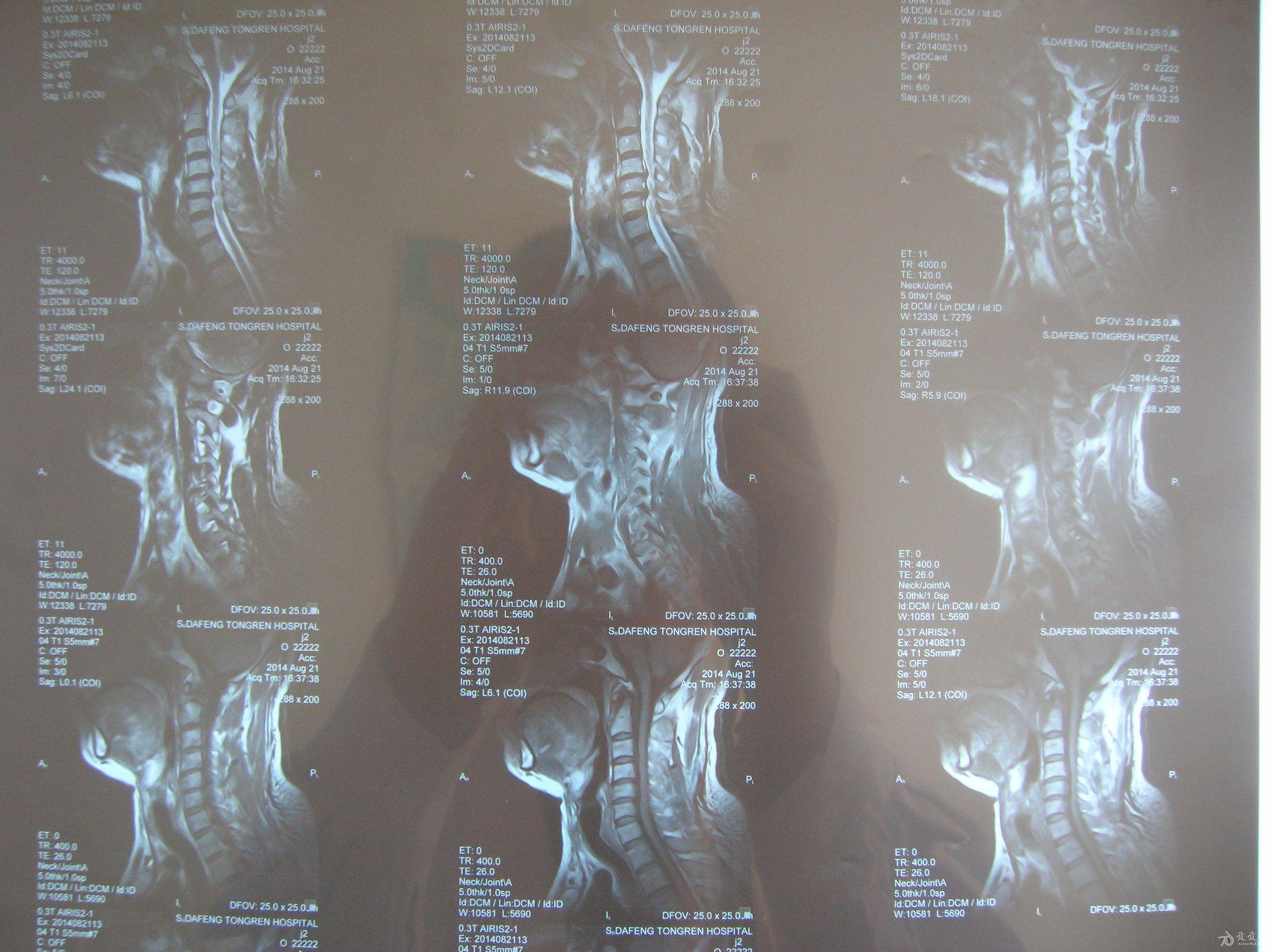 幫我看看脊髓型頸椎病的片子