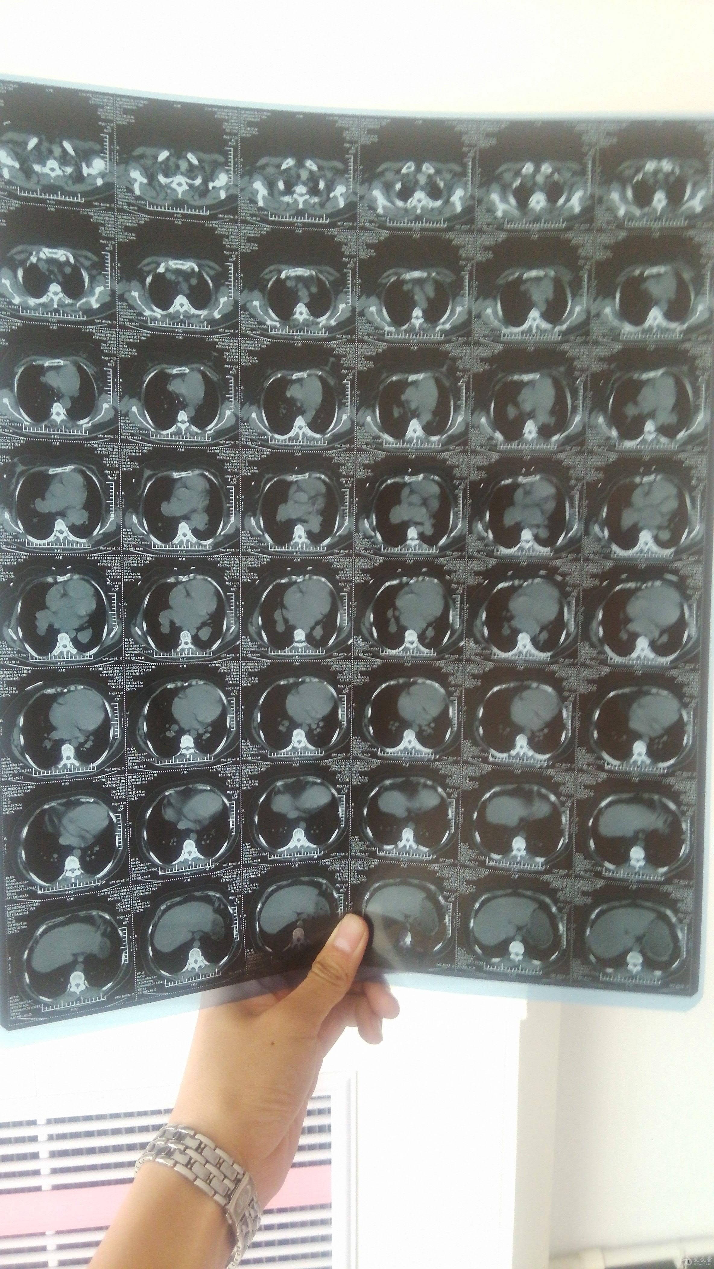 会诊胸ct有结果请协助诊断