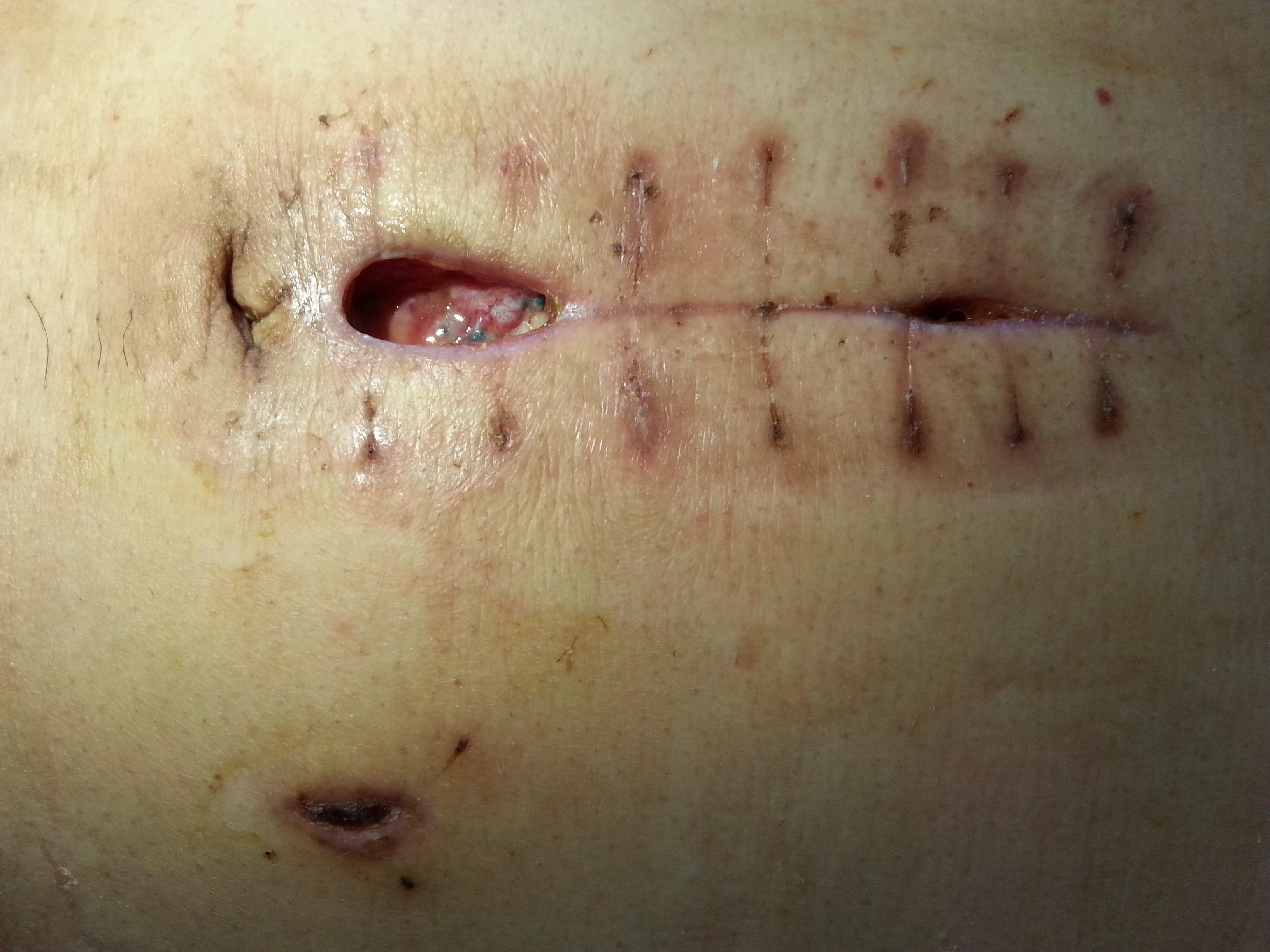 肠套叠手术伤口图片图片