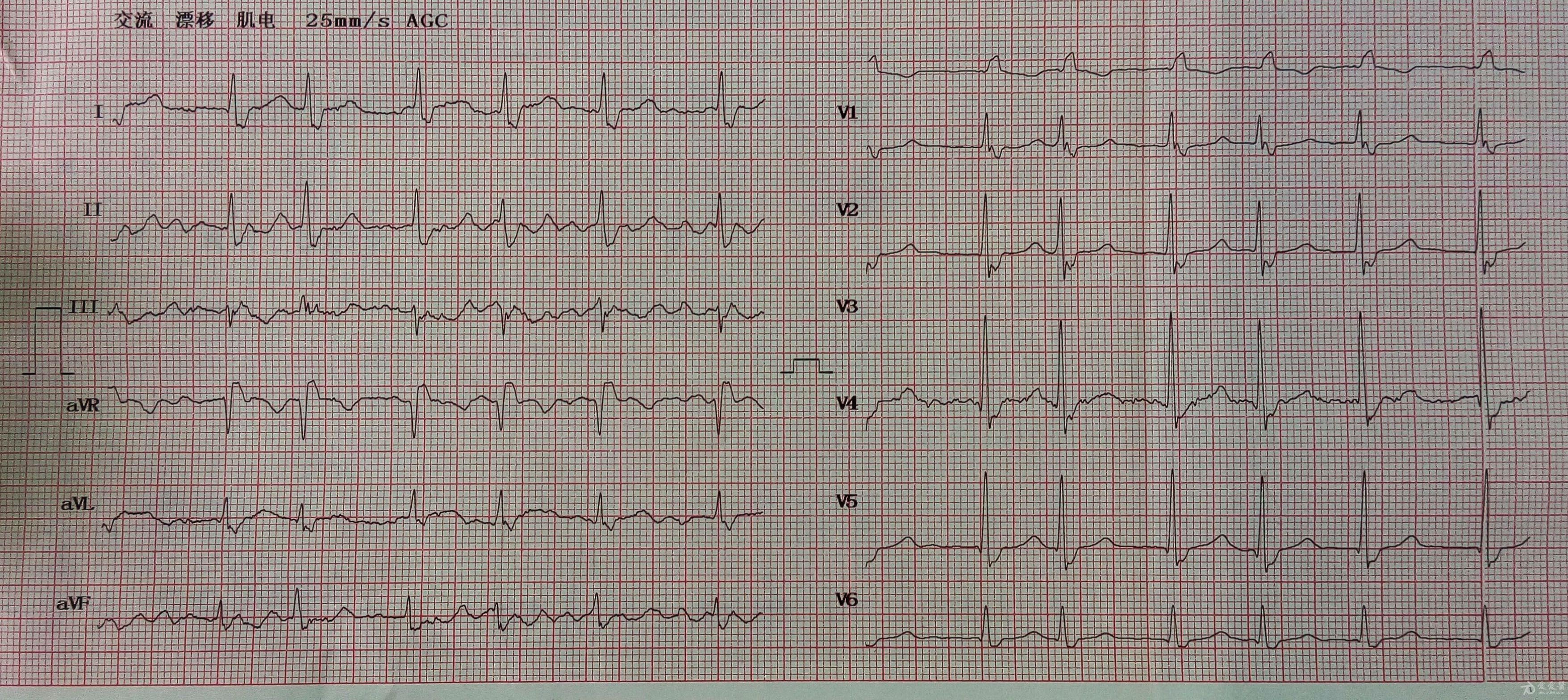 请大家帮忙分析一个心电图