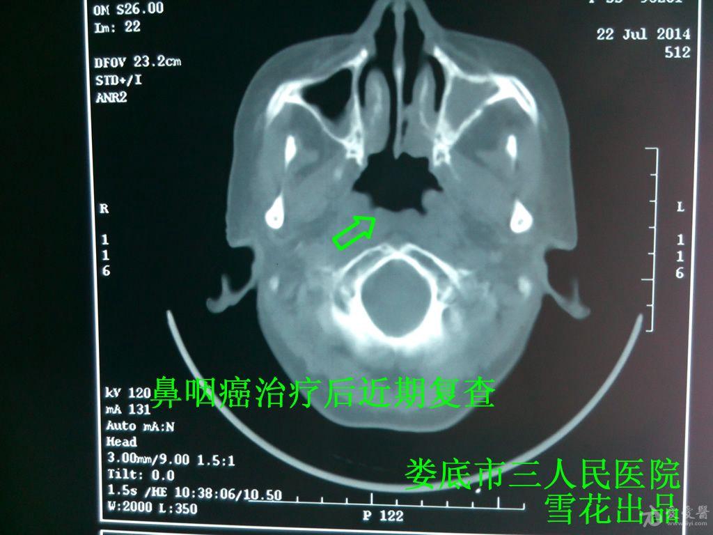 雪花医案第22期--没有颈淋巴结转移的鼻咽癌一定要化疗吗?
