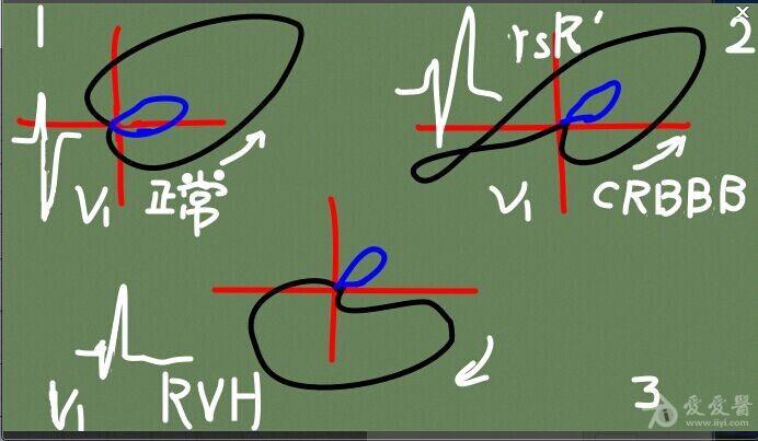 【分析心电图】大家来讨论心电图