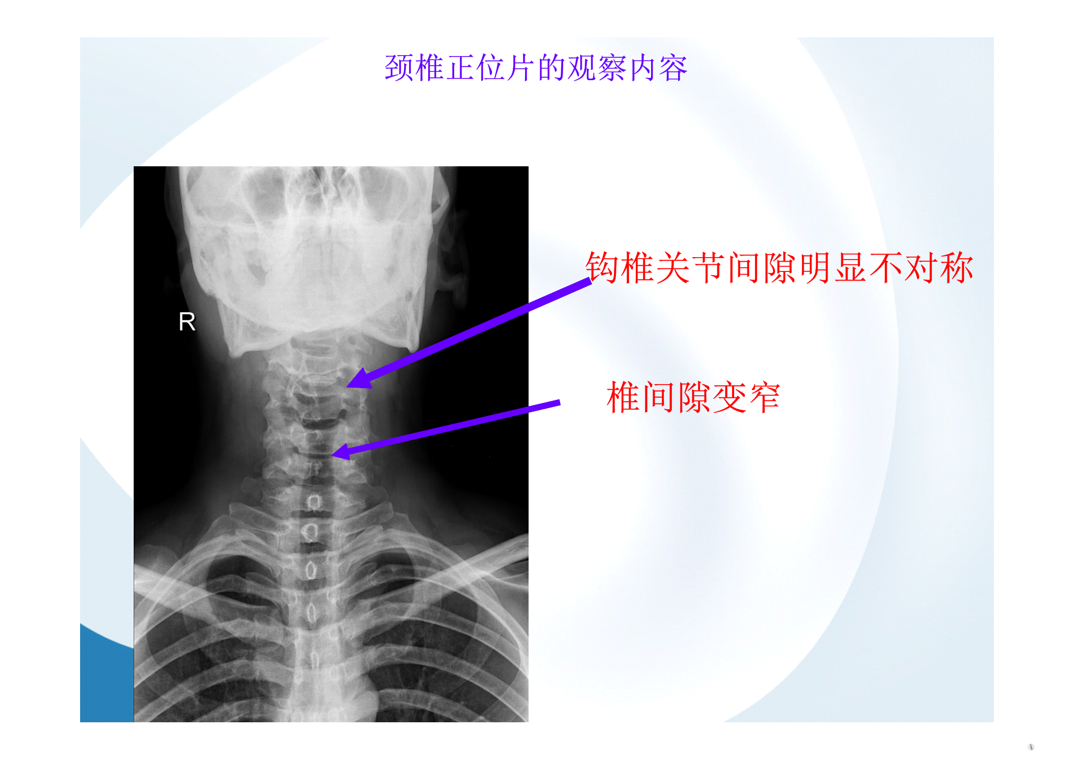 颈椎读片方法与颈椎病影像表现灰狼吐血原创转载请注明出处
