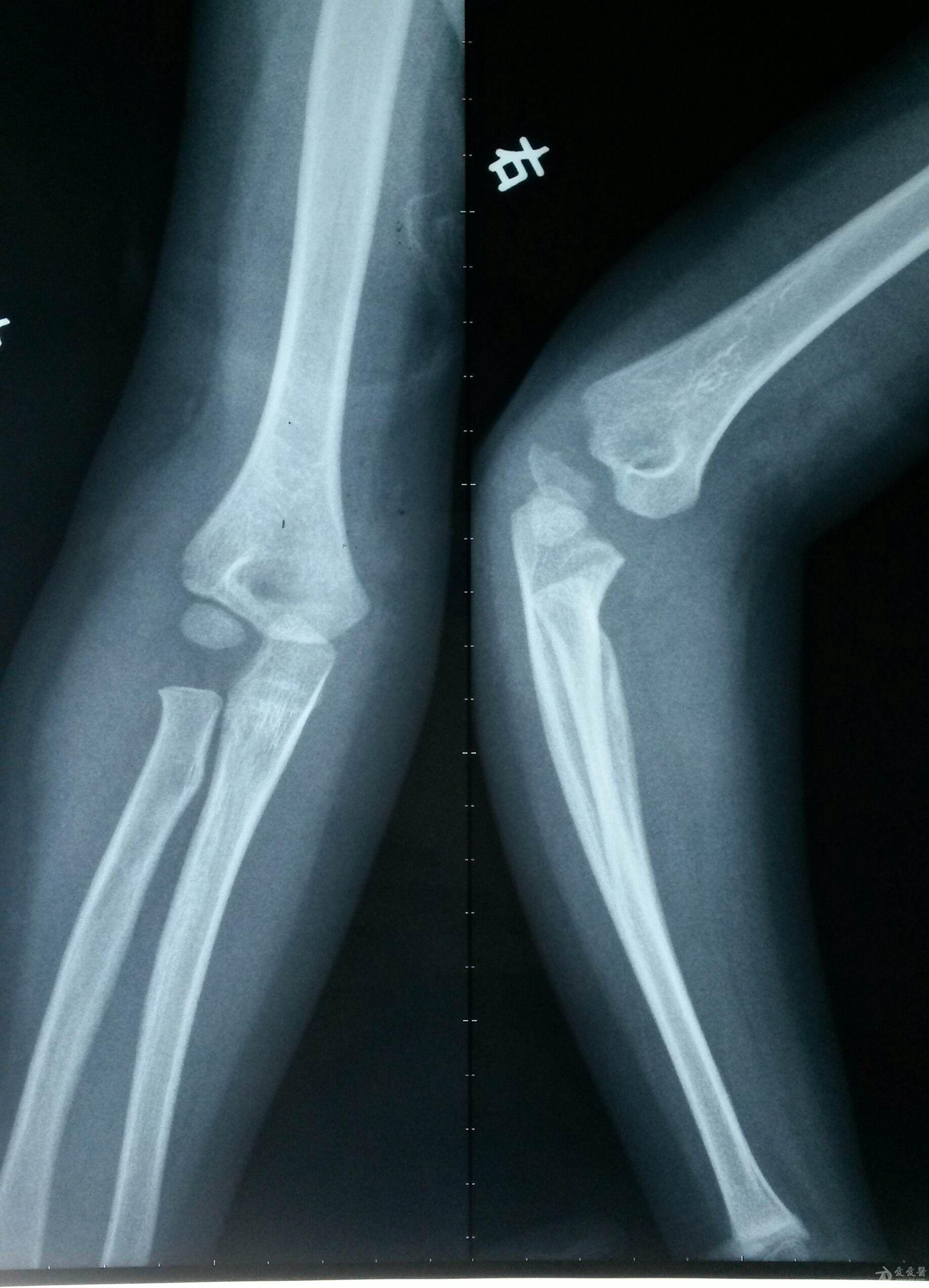 小孩右手肱骨骨折图片图片