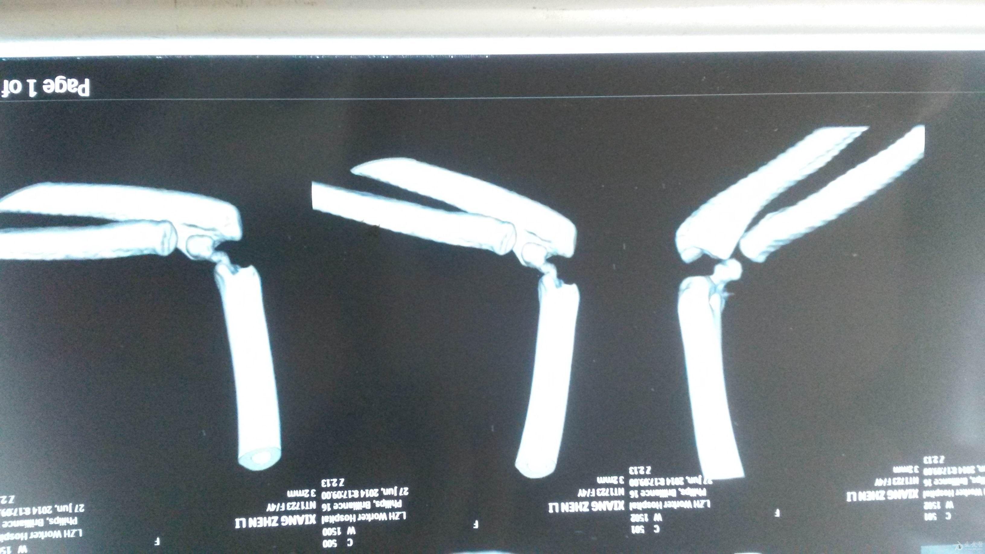 小儿肱骨外髁骨折