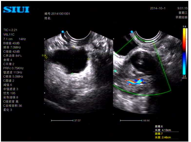 盆腔积液,左侧卵巢囊占位