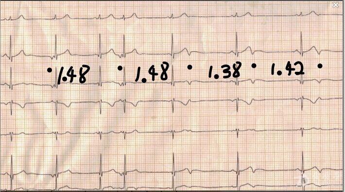 请老师帮忙看看这个小孩心电图怎么诊断谢谢