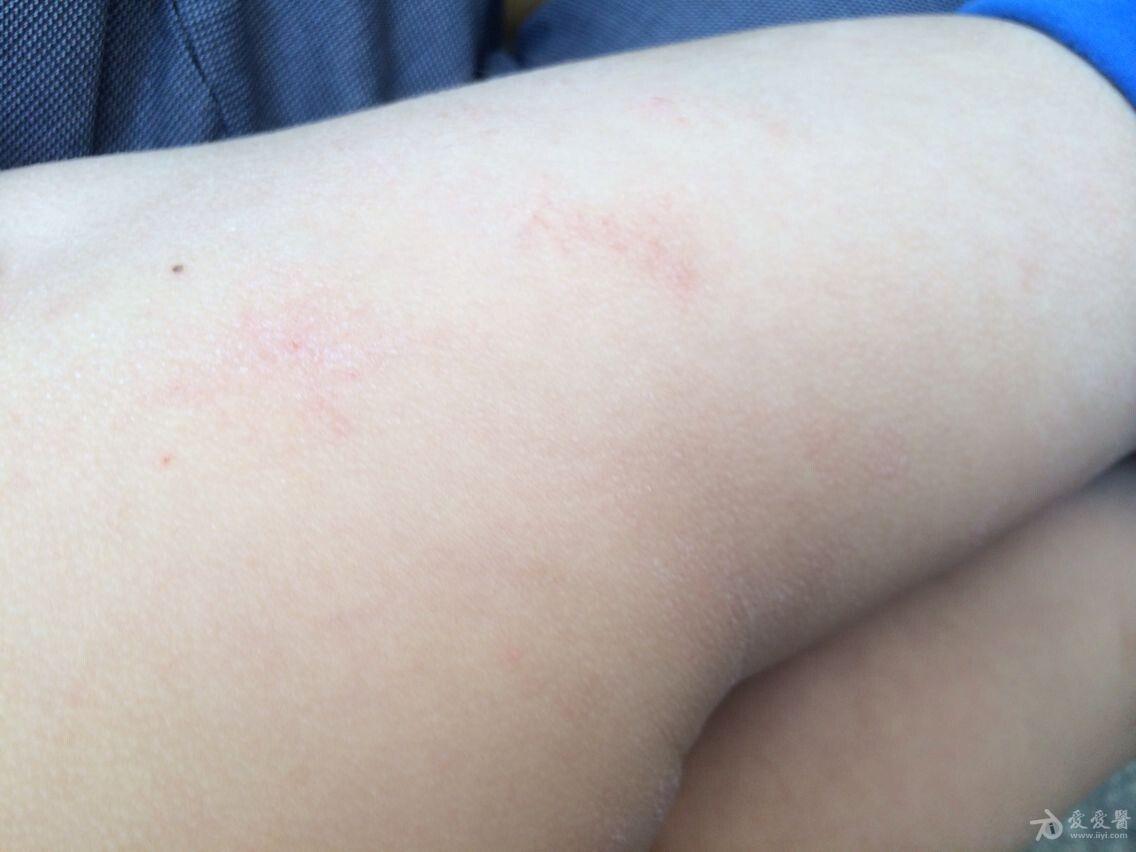 玫瑰糠疹鸡皮肤(玫瑰糠疹可不可以吃鸡)