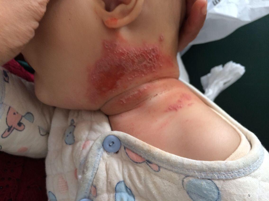 婴儿隐翅虫皮炎